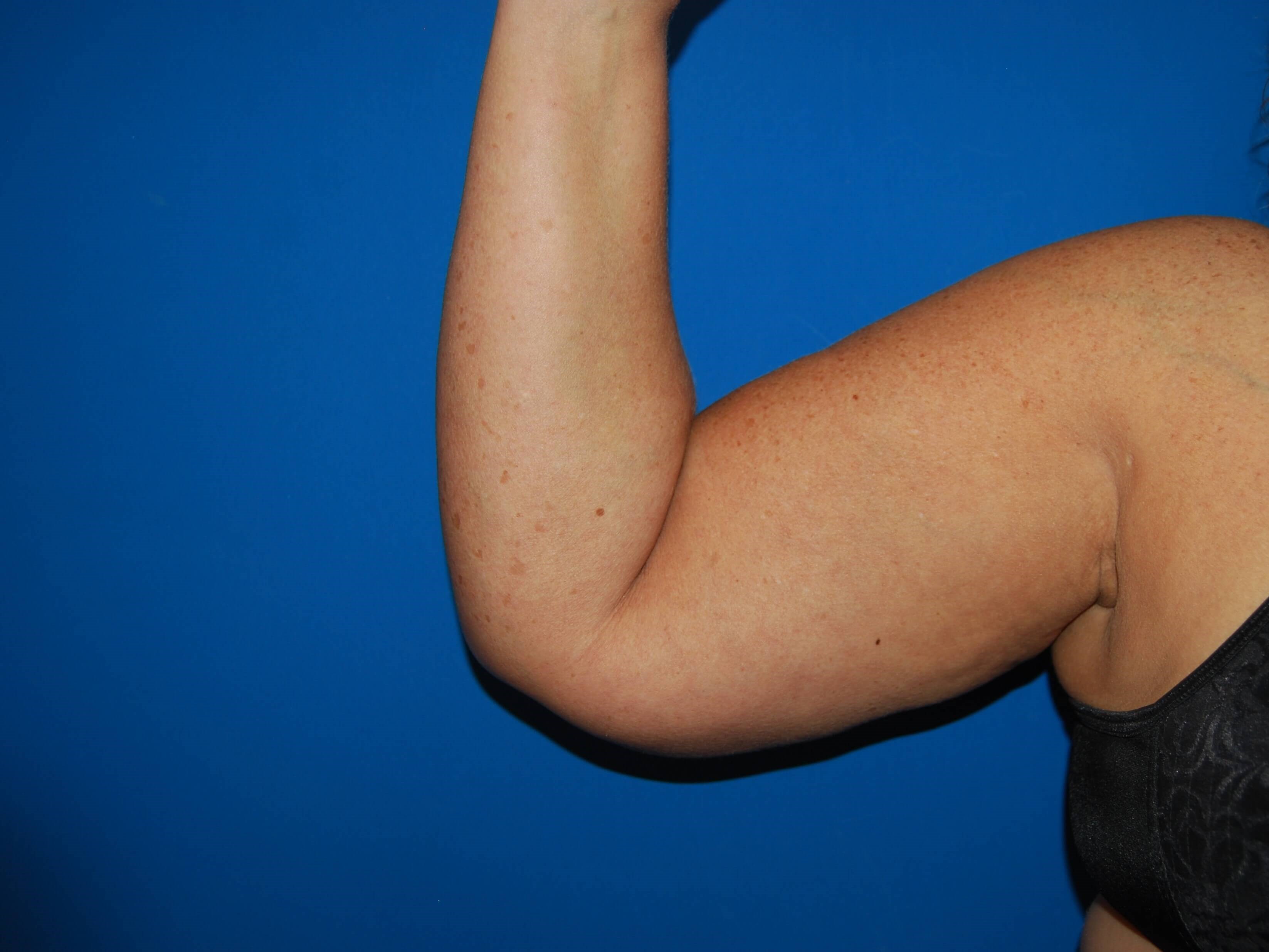 Inner Arm- Right Before  Arm Lift