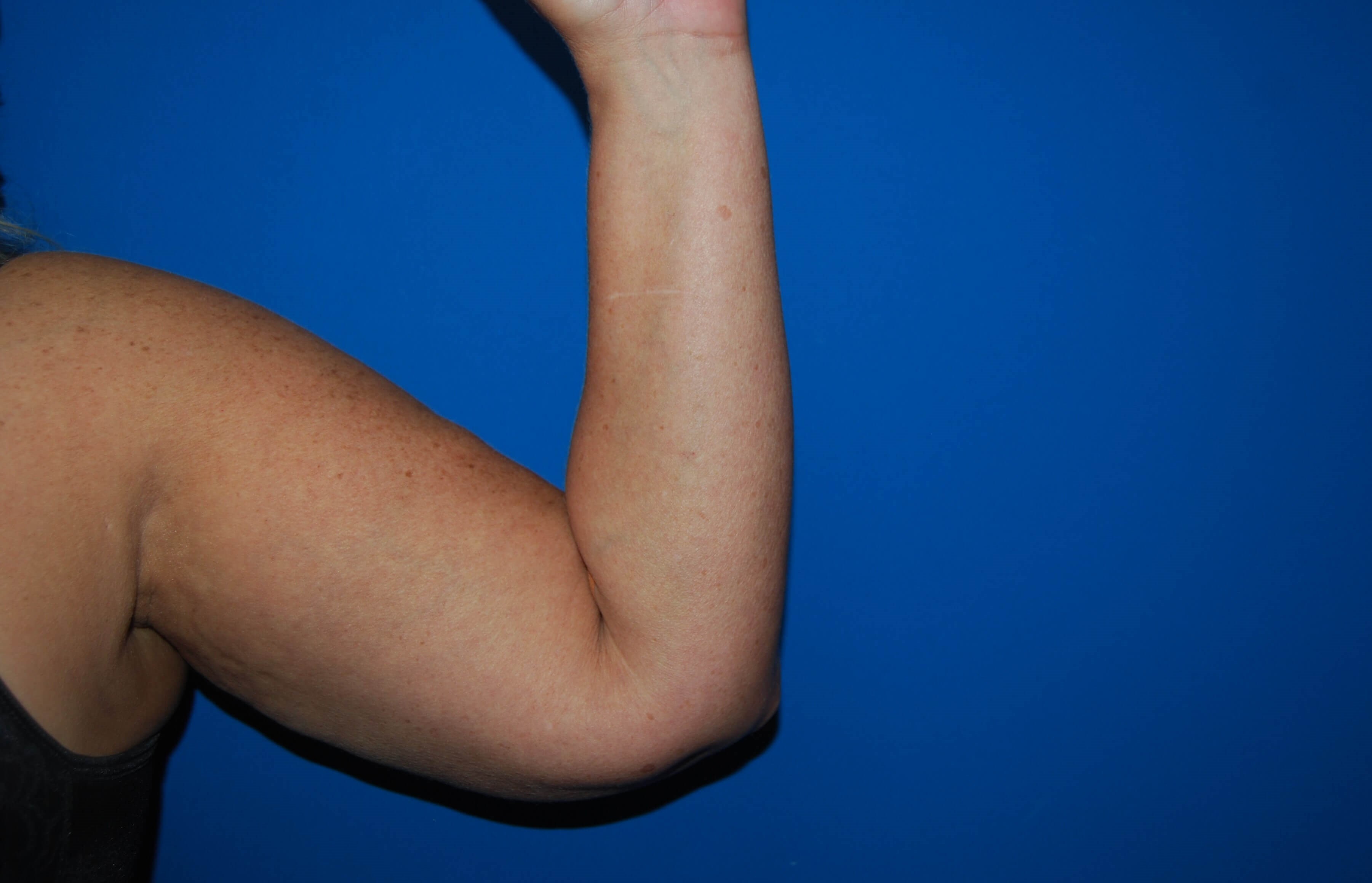 Inner Arm- Left Before  Arm Lift
