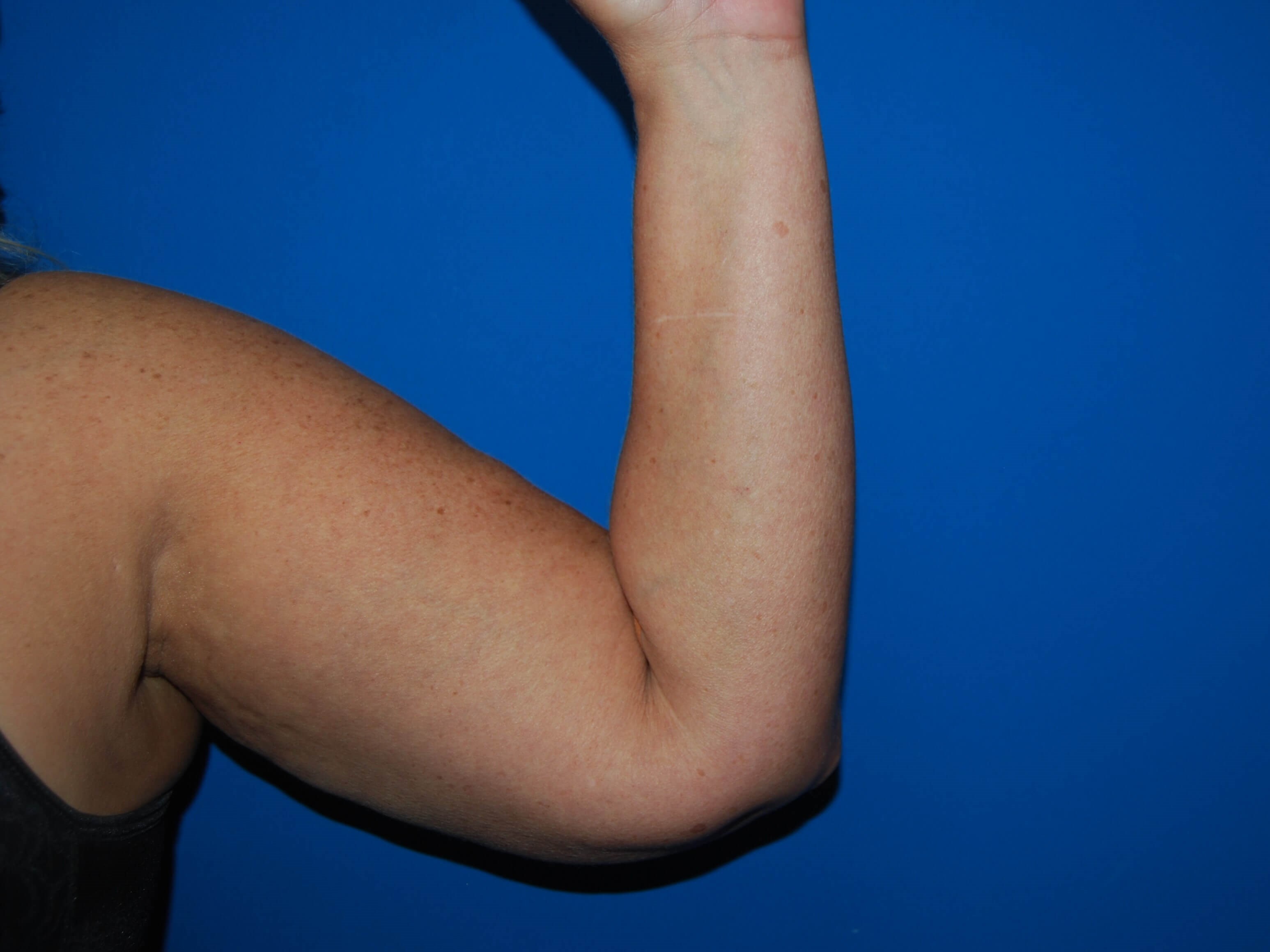 Inner Arm- Left Before  Arm Lift