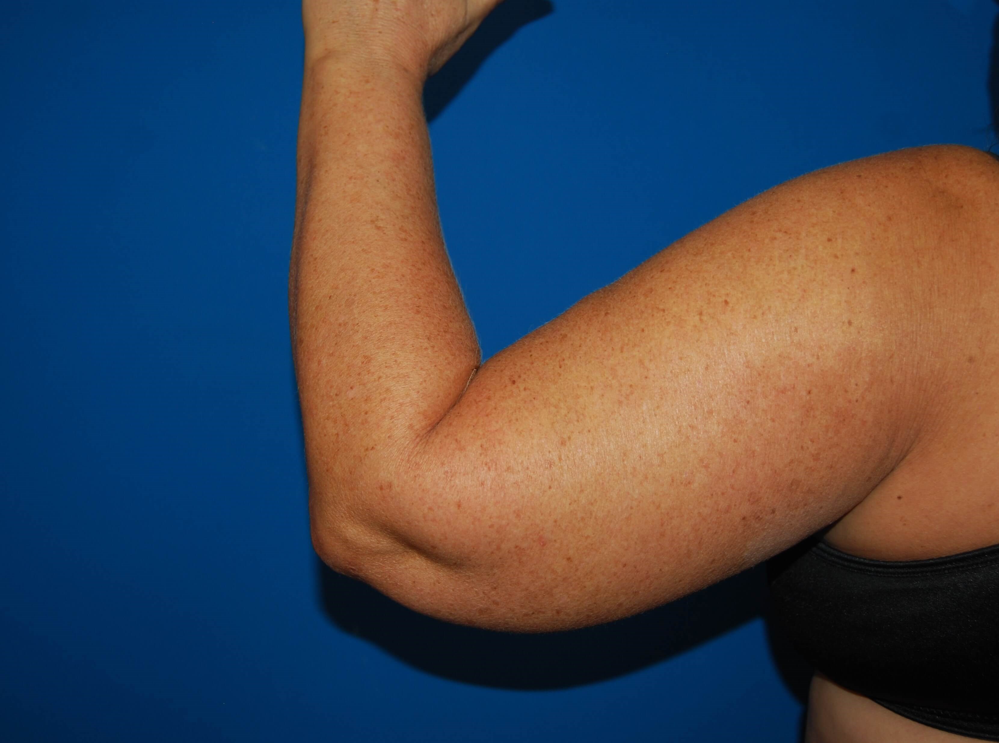 Outer View - Left Before  Arm Lift