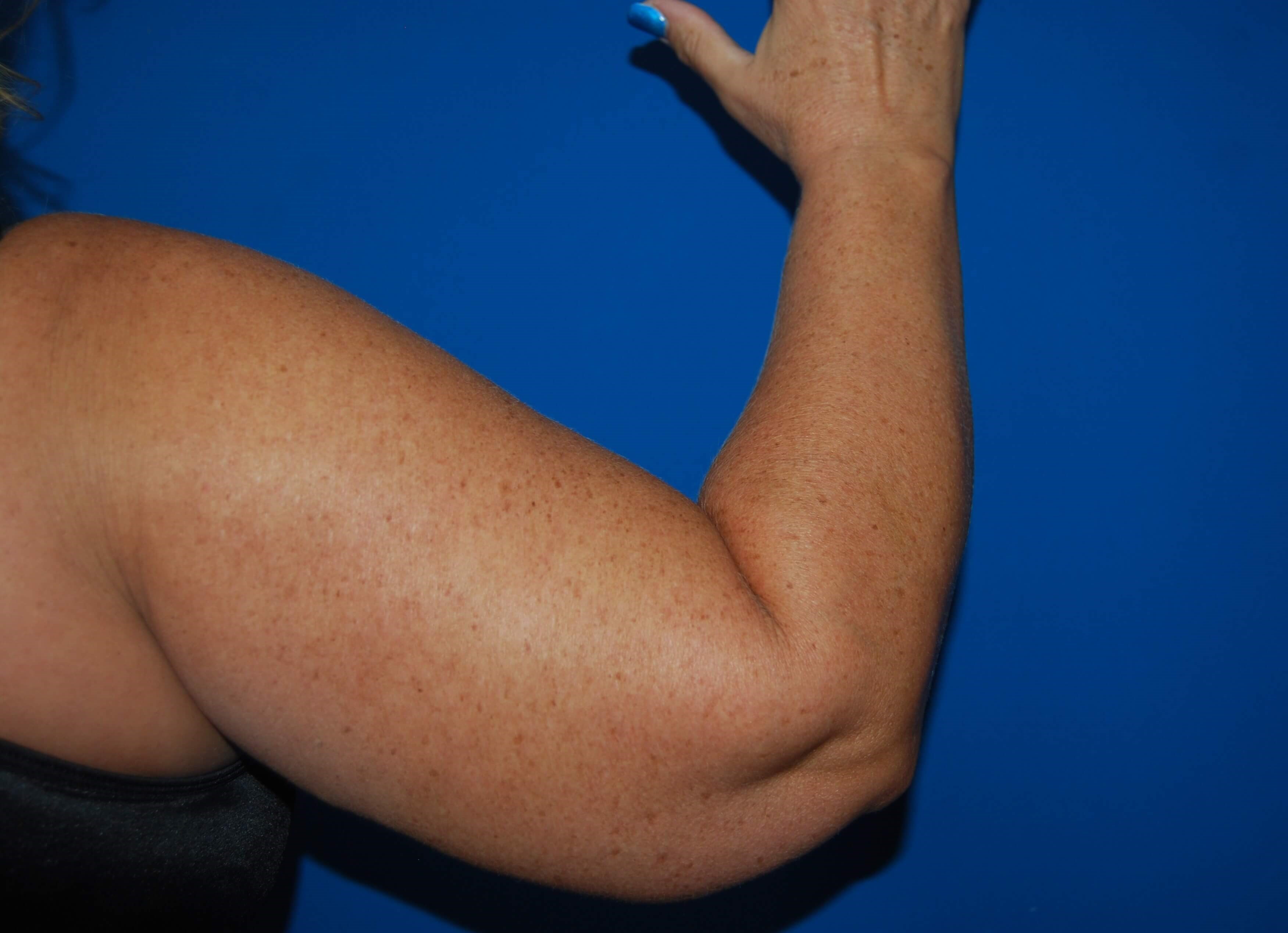 Outer View - Right Before  Arm Lift