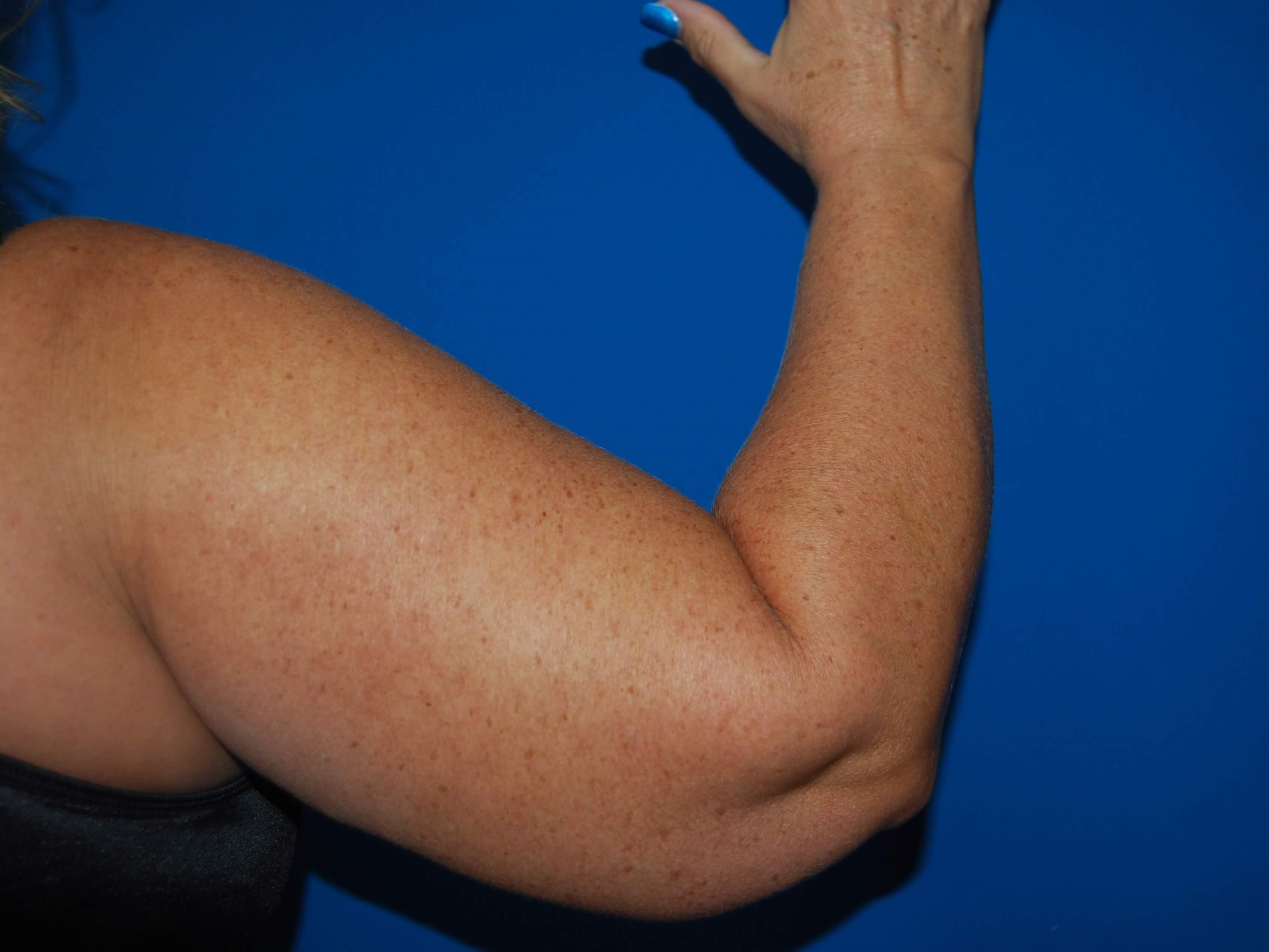 Outer View - Right Before  Arm Lift