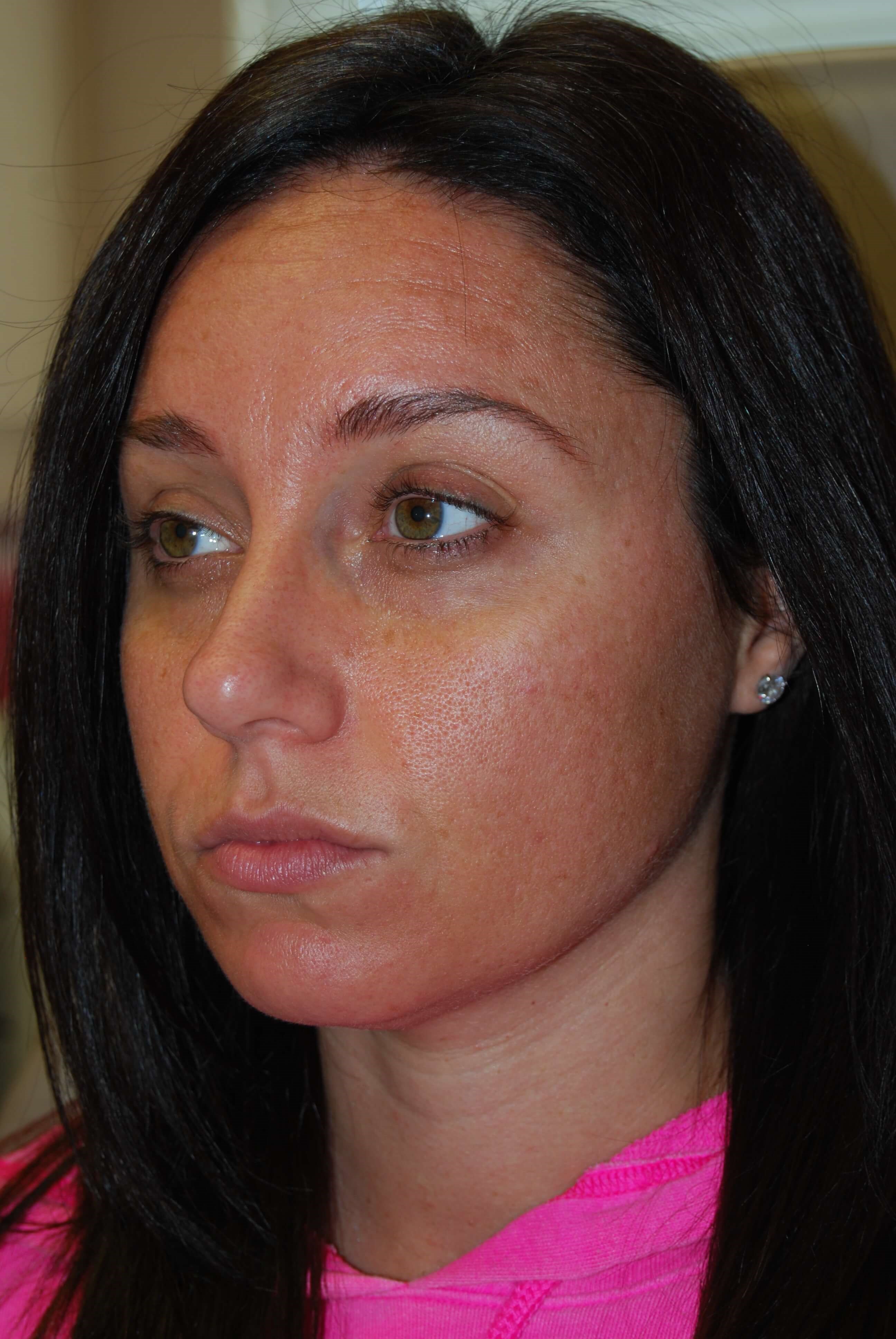 Lip Filler Before
