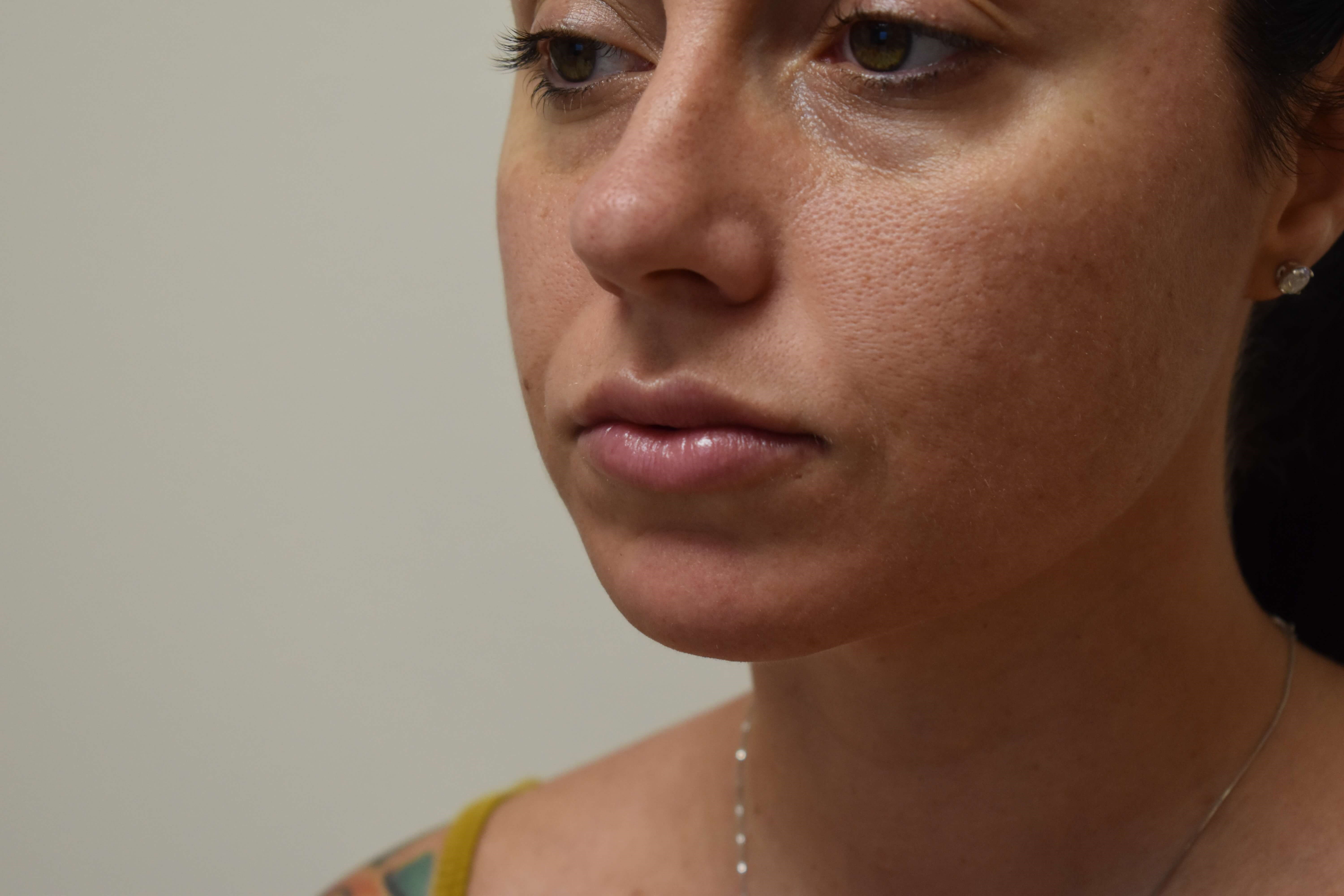 Lip Filler After