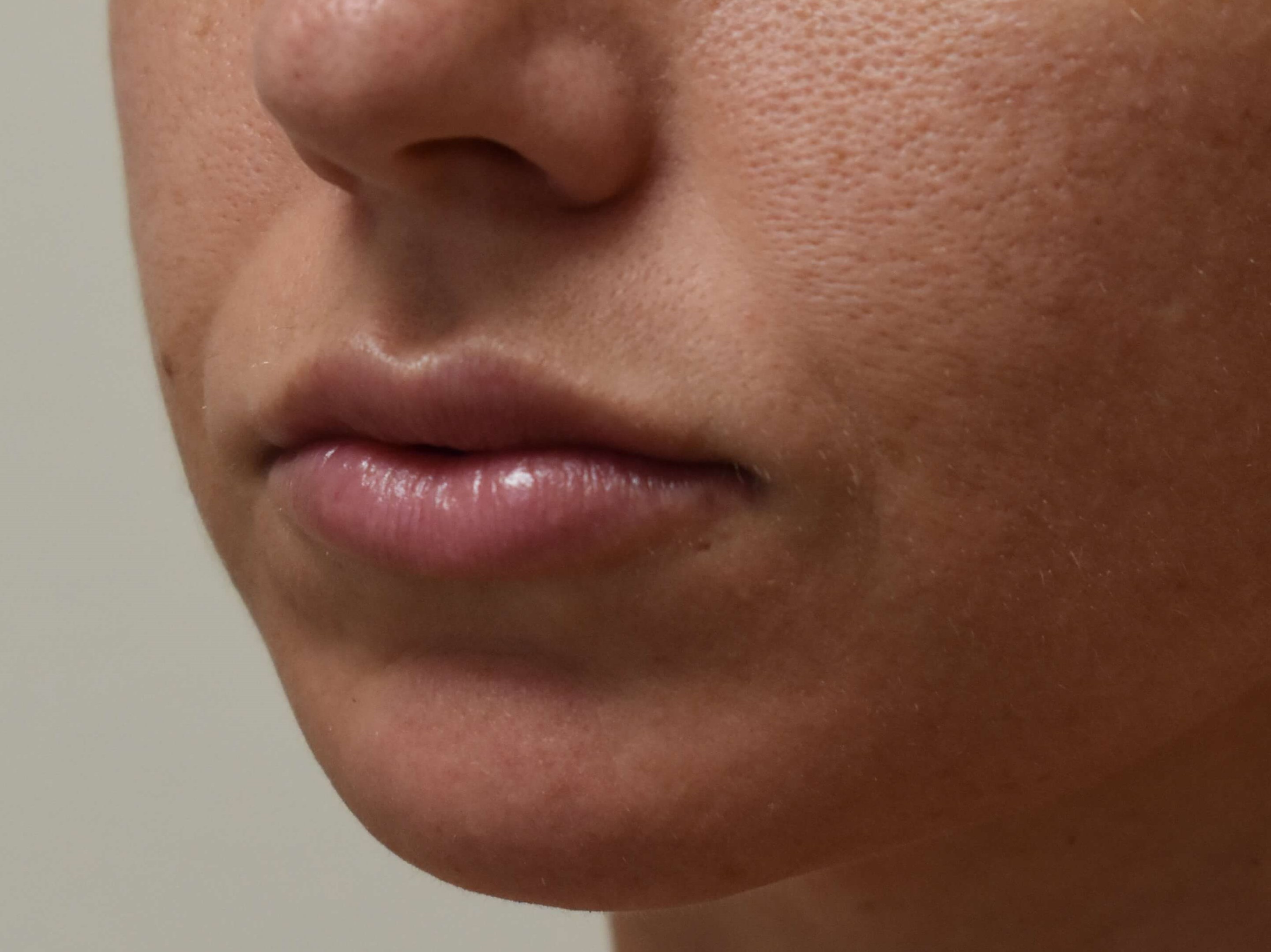 Lip Filler After