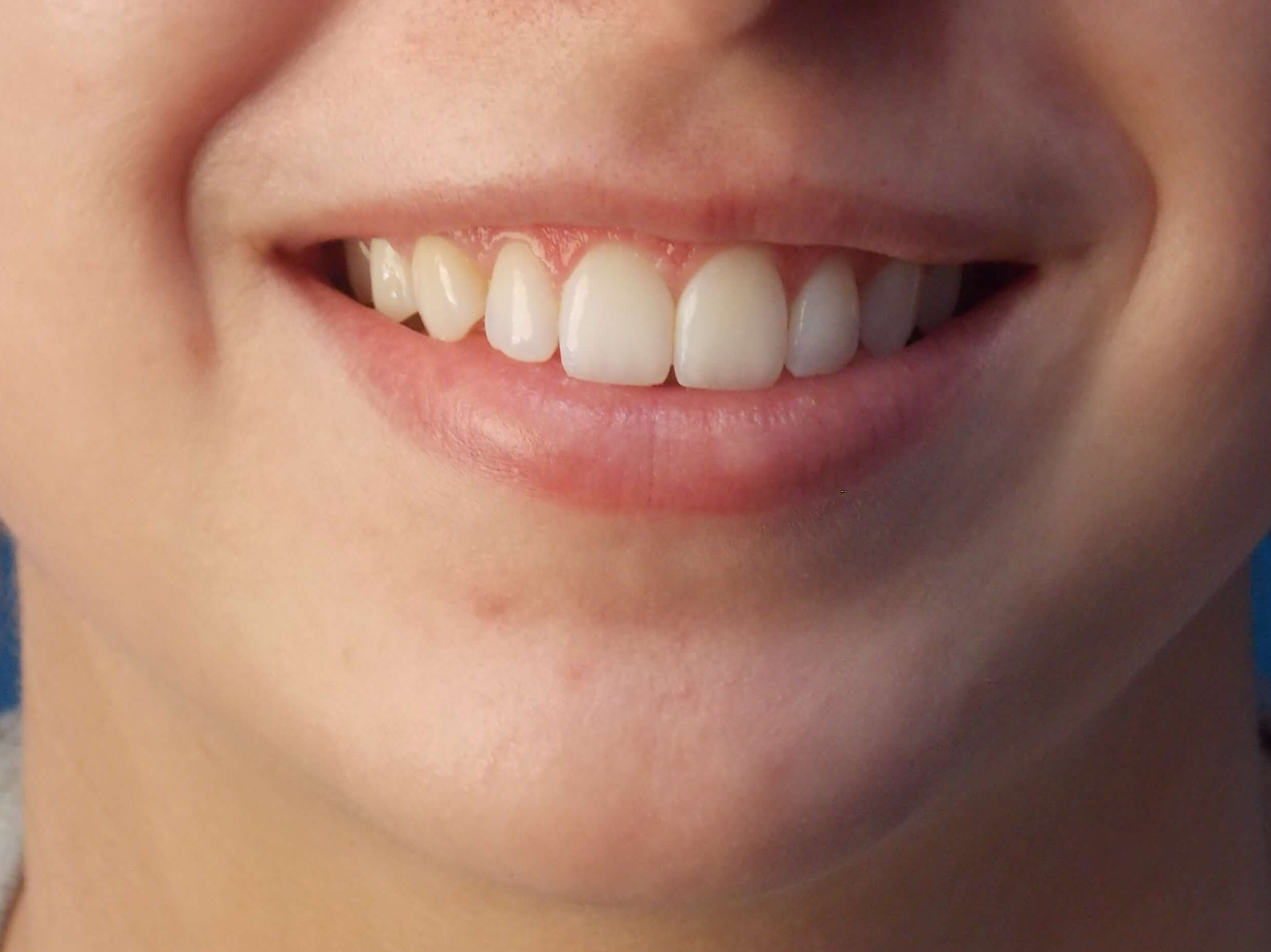 Lip Filler Before
