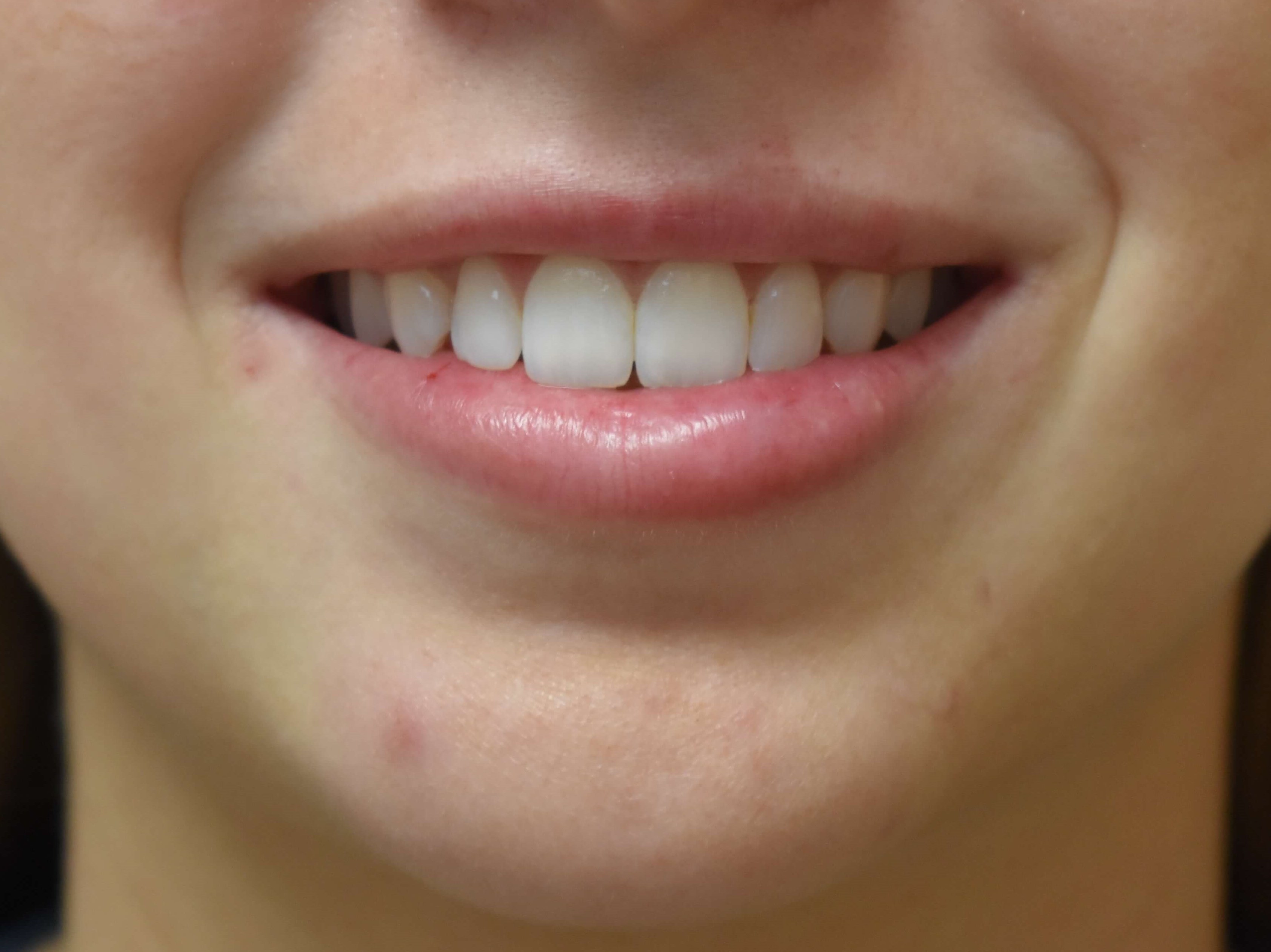 Lip Filler After