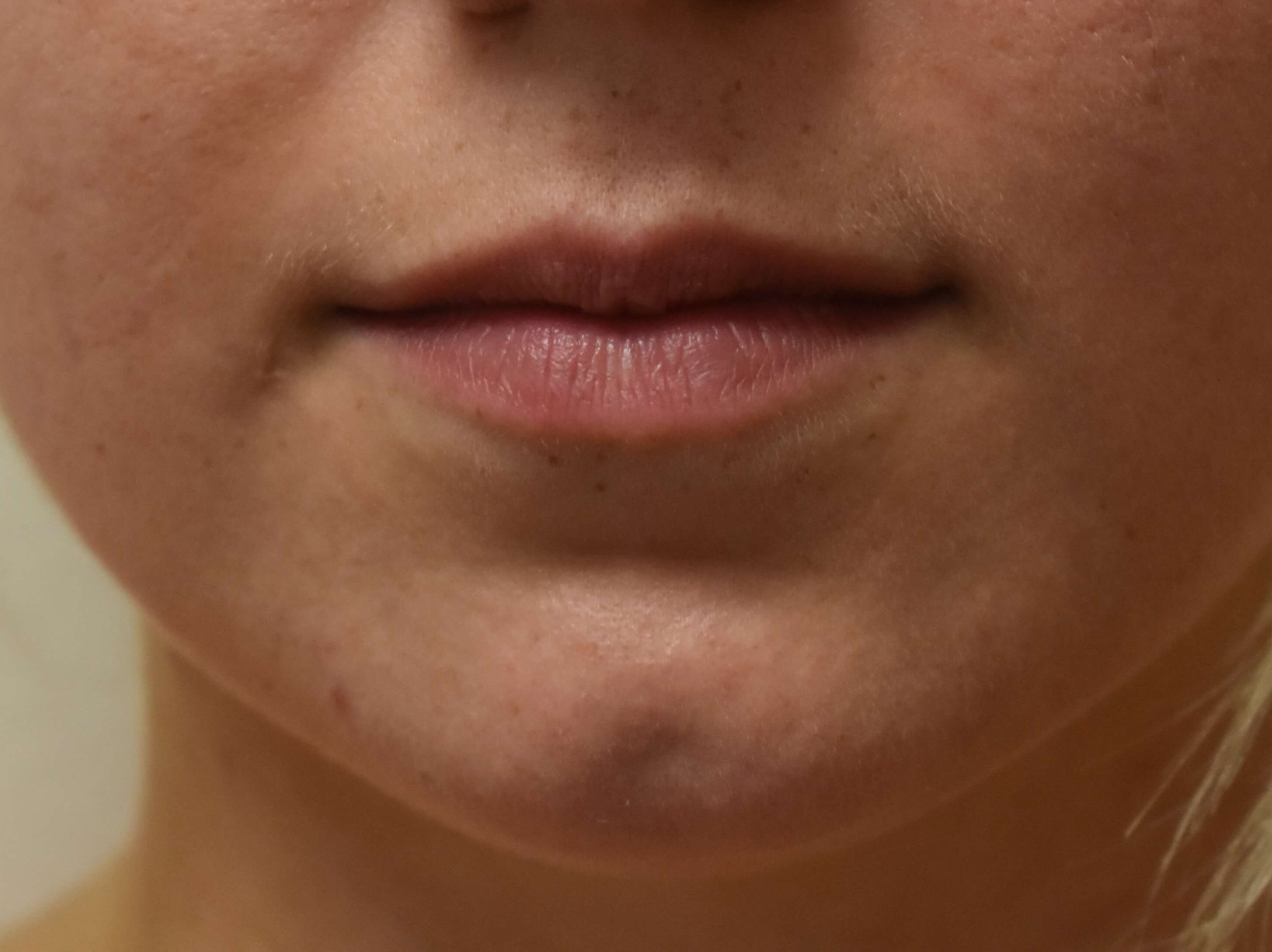 Lip Filler Before and After Before