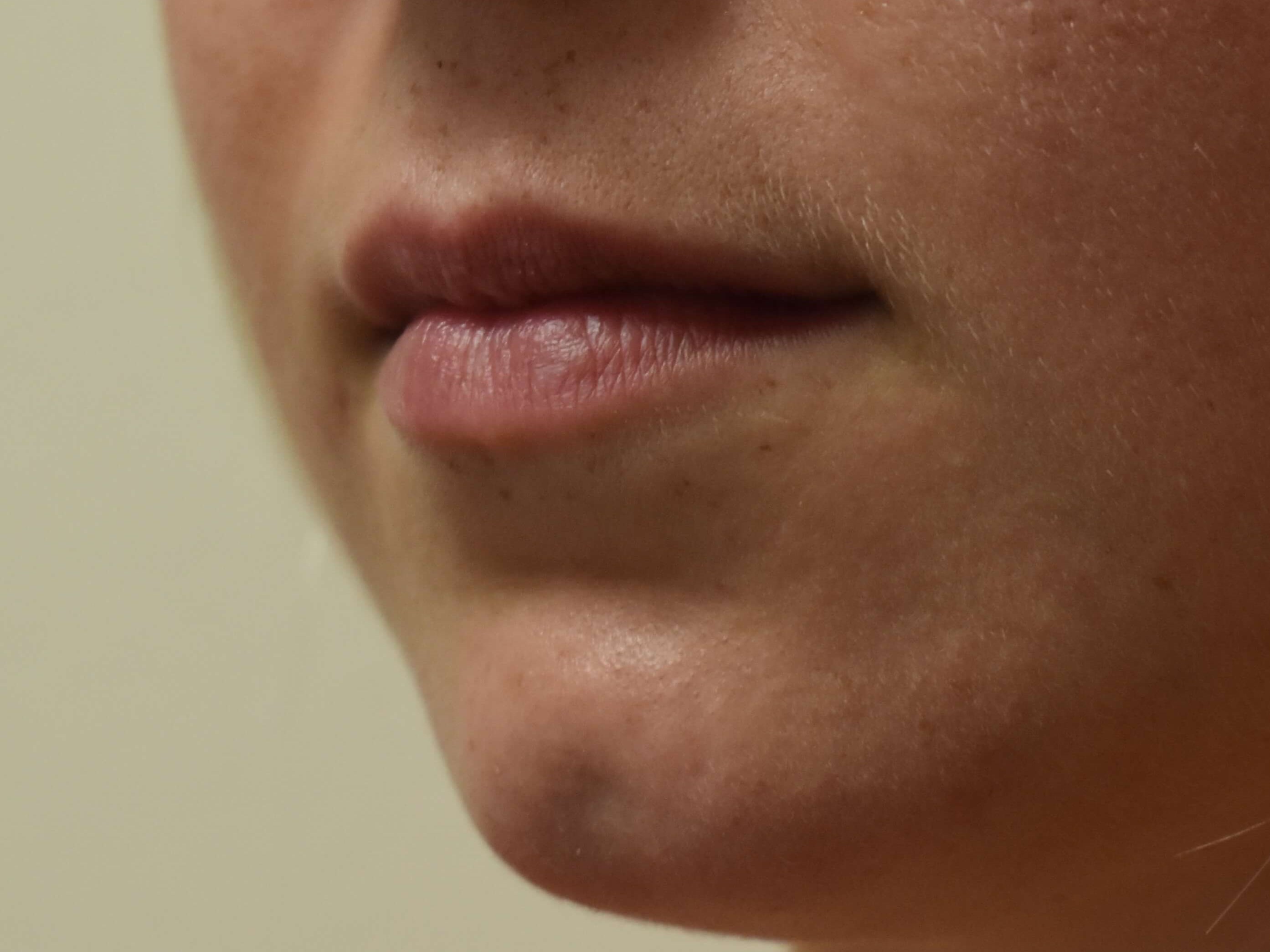 Lip Filler Before and After Before