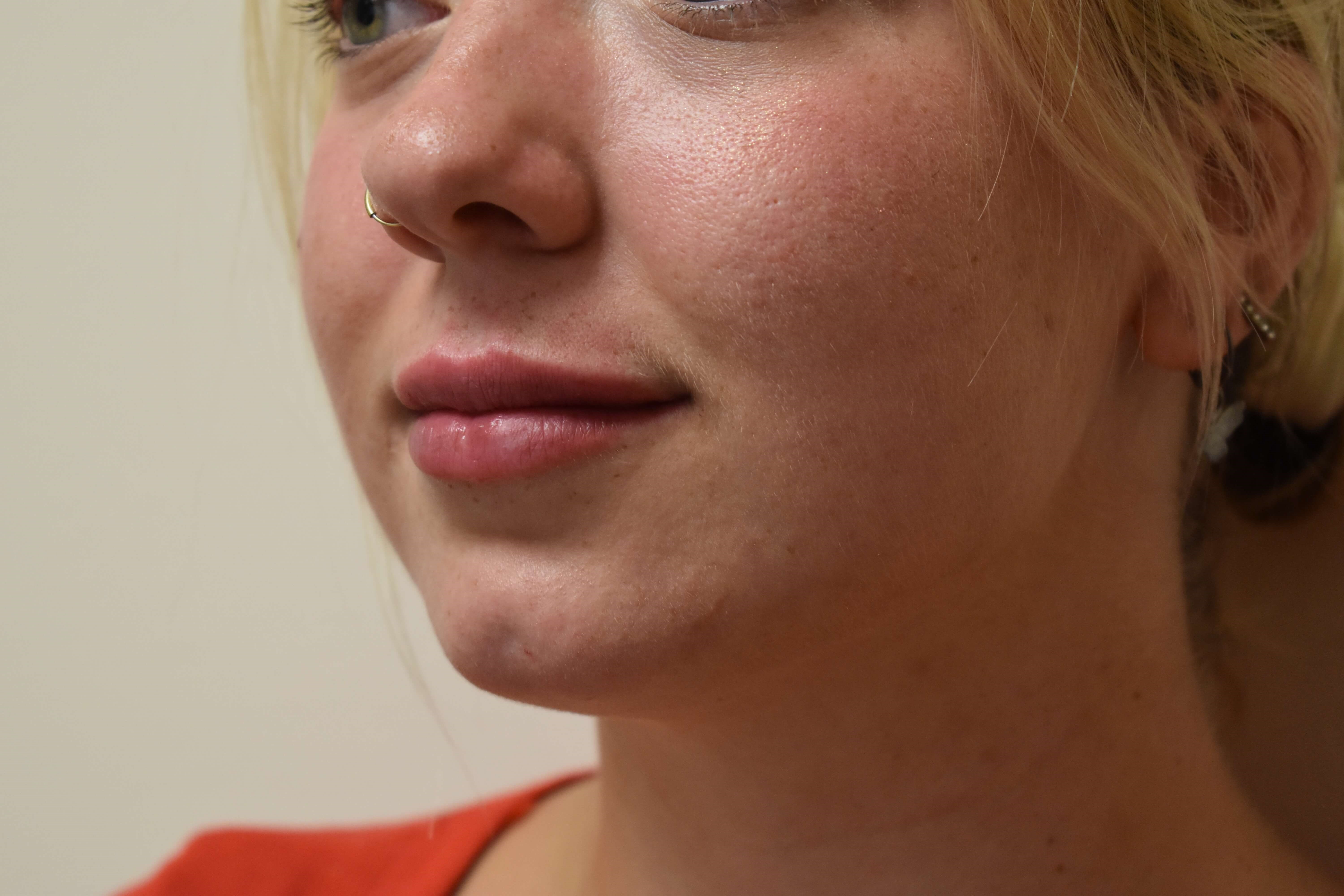 Lip Filler Before and After After