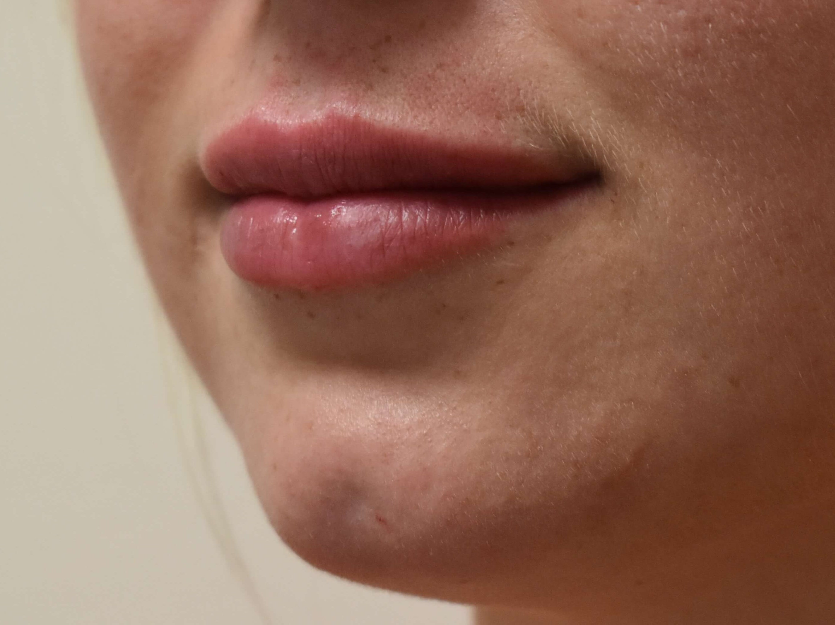 Lip Filler Before and After After