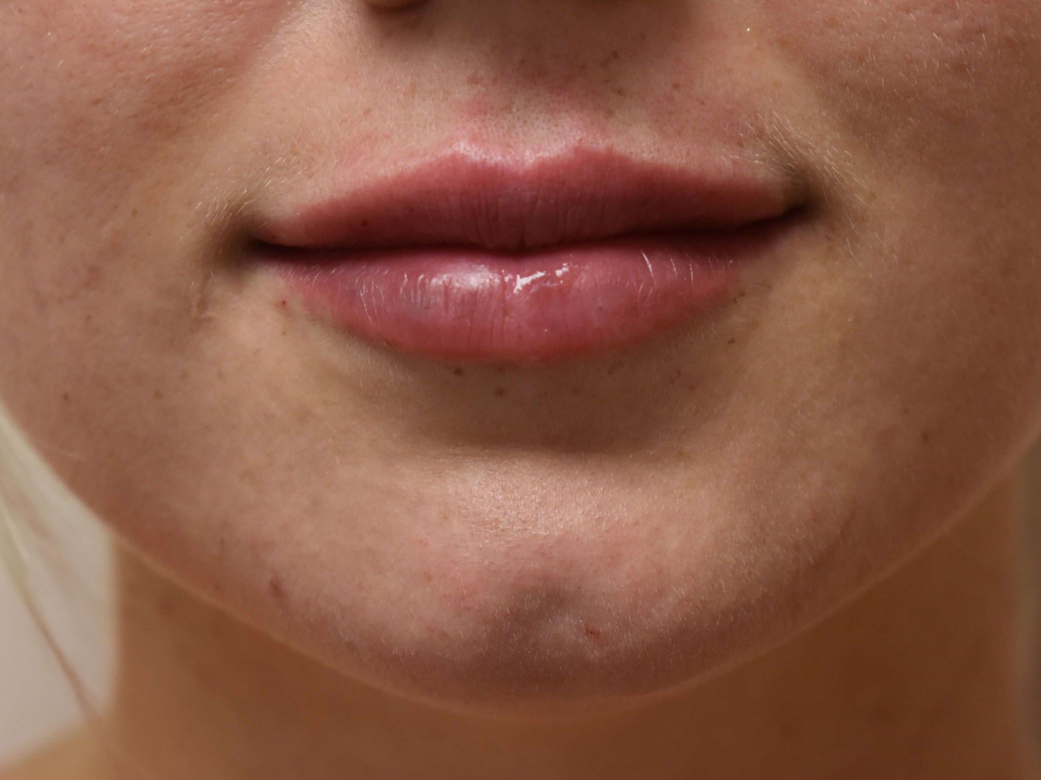 Lip Filler Before and After After