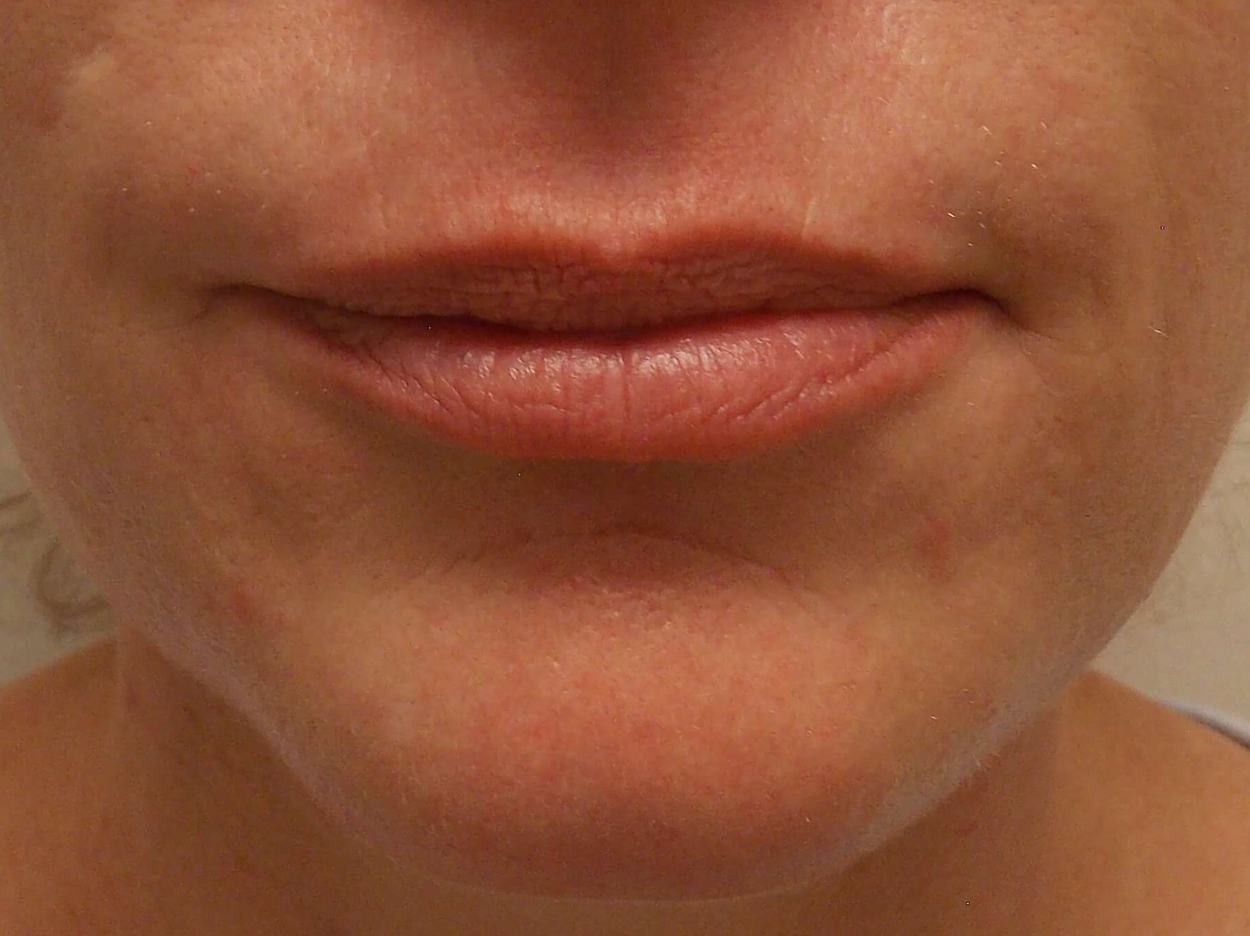 Lip Injections Before