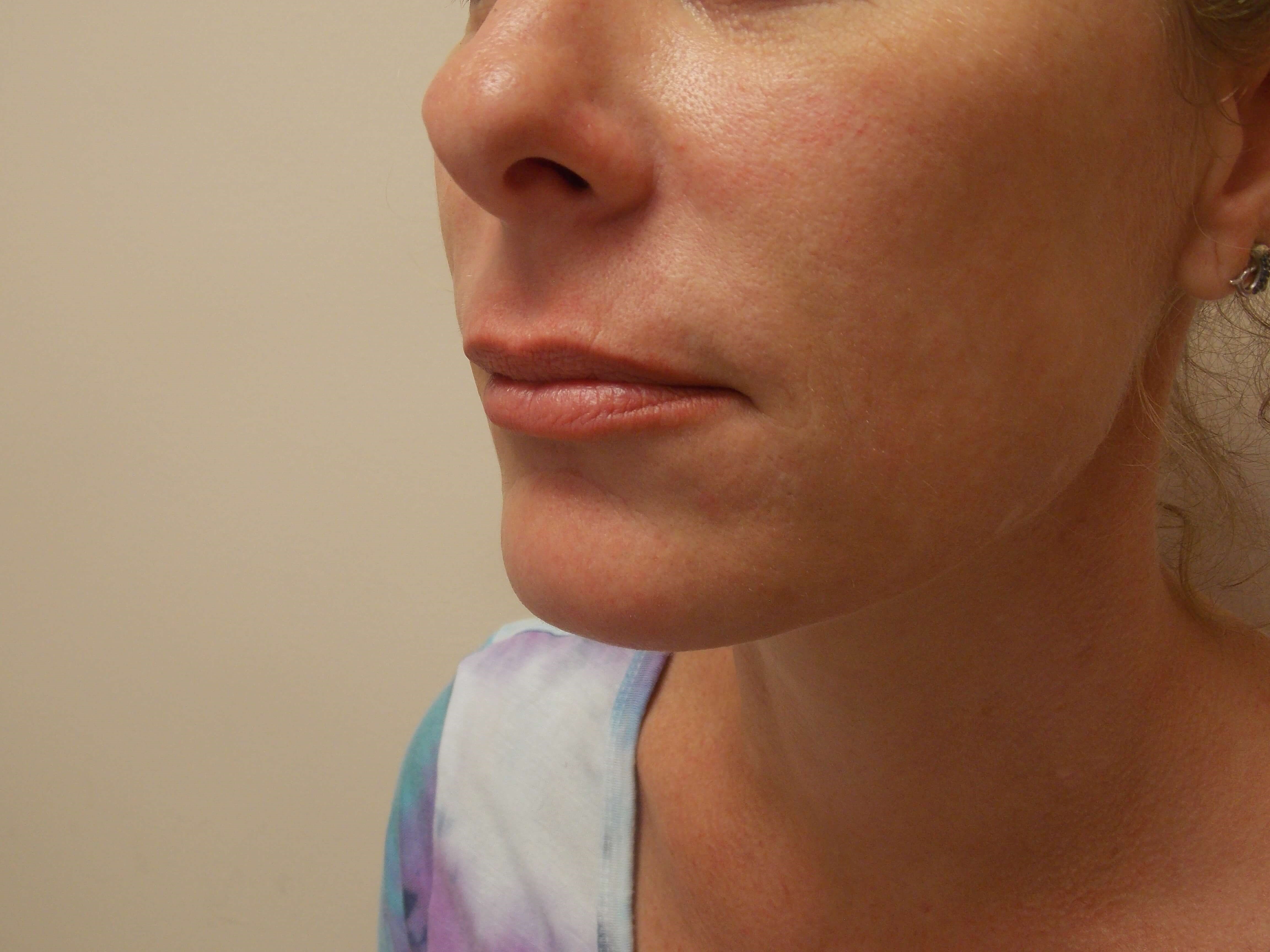 Lip Injections Before