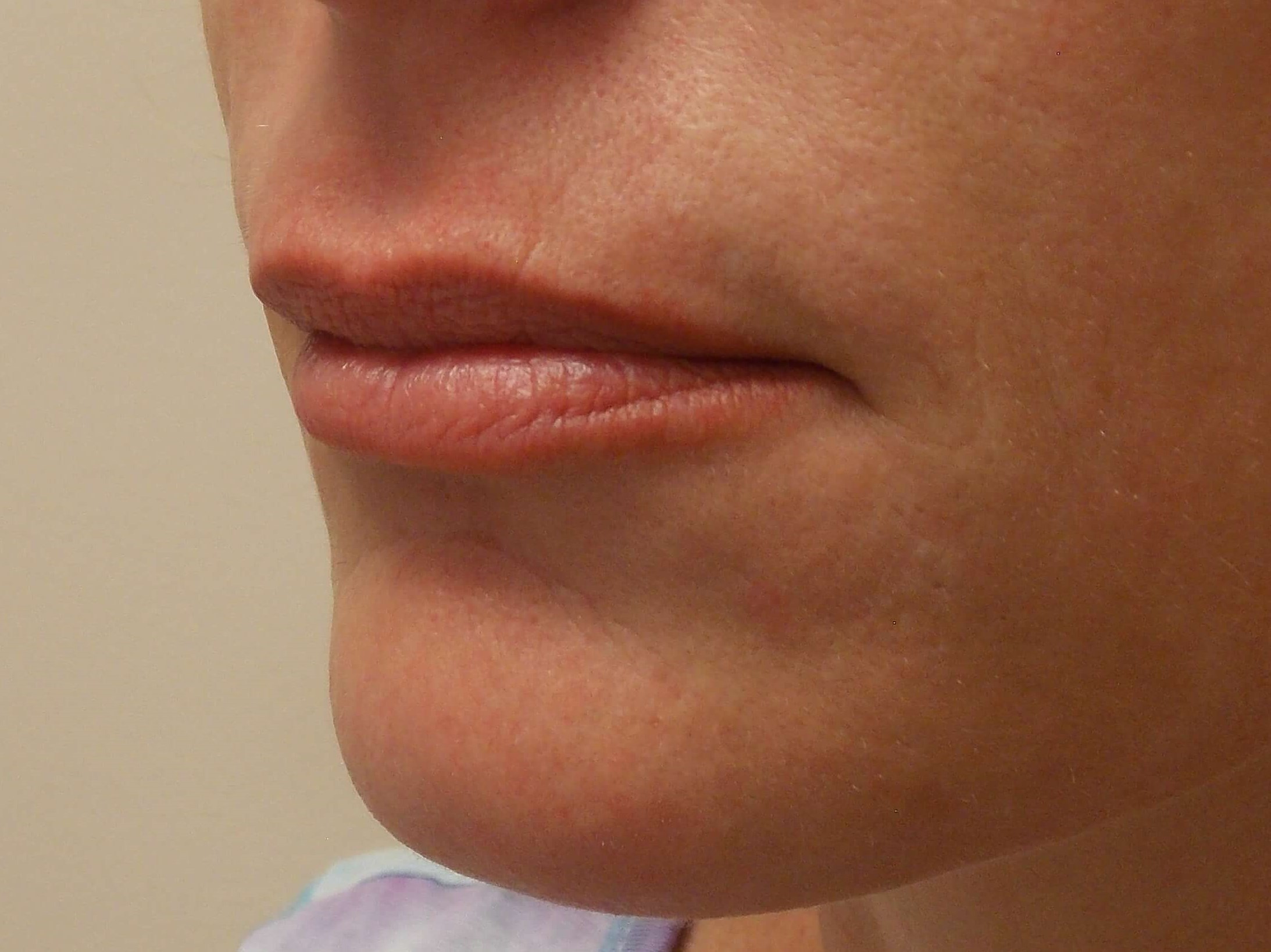 Lip Injections Before