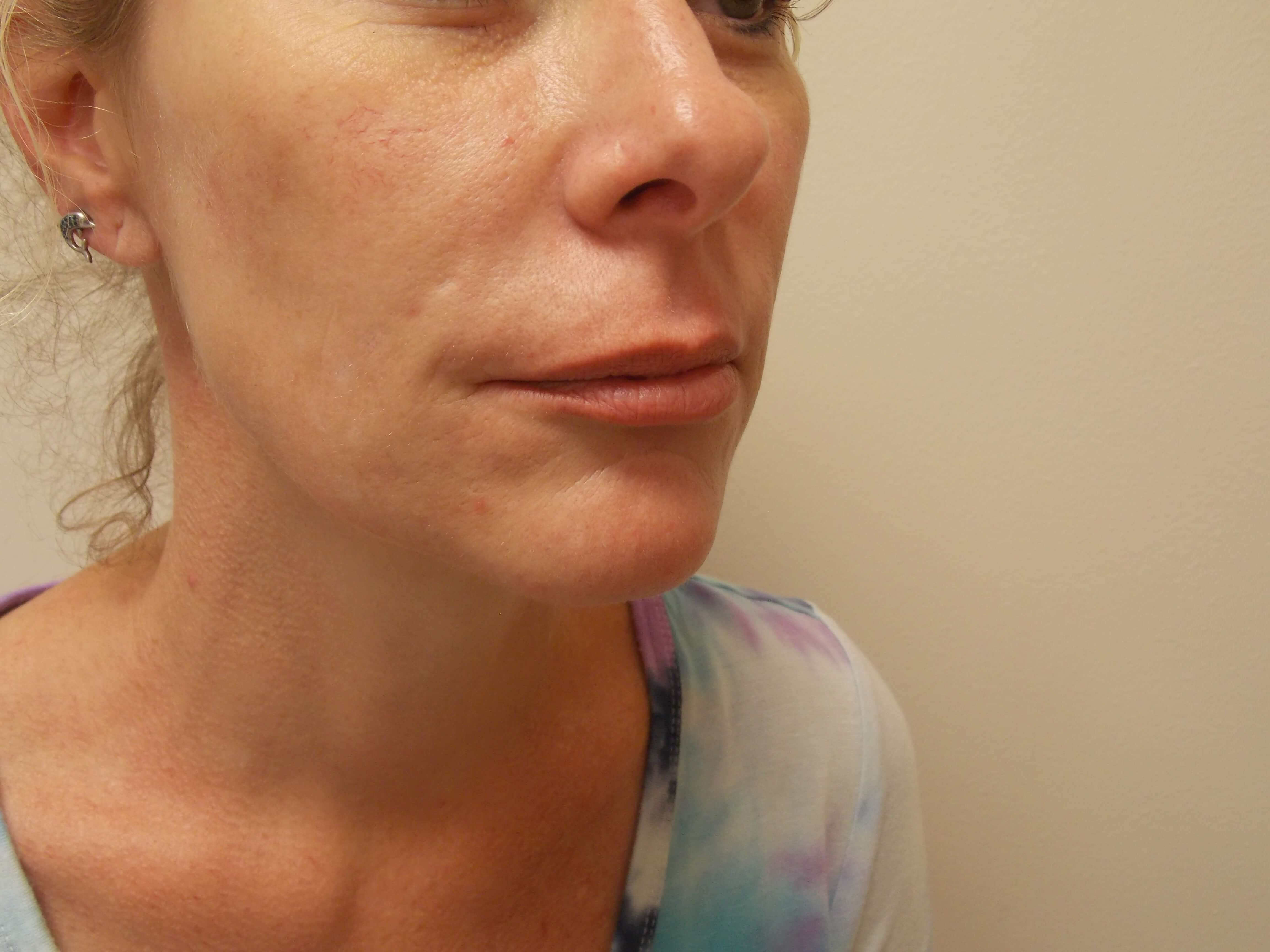 Lip and Nasolabial Fold Filler Before
