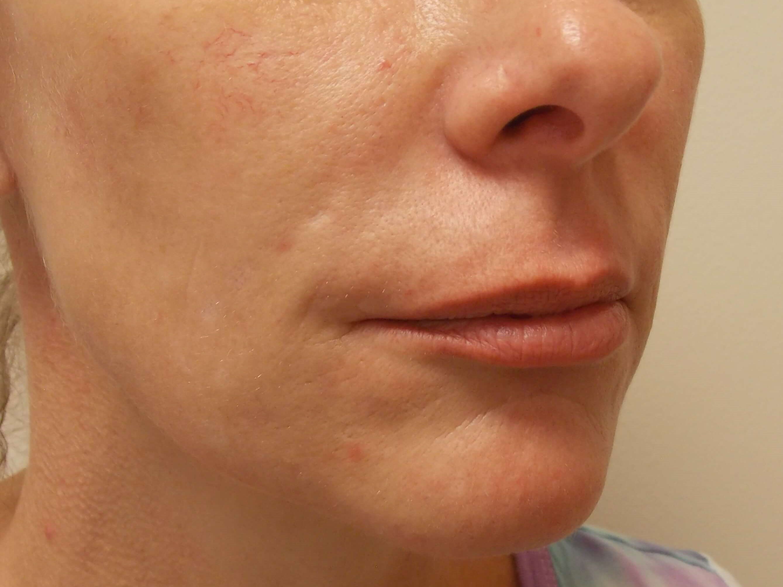 Lip and Nasolabial Fold Filler Before