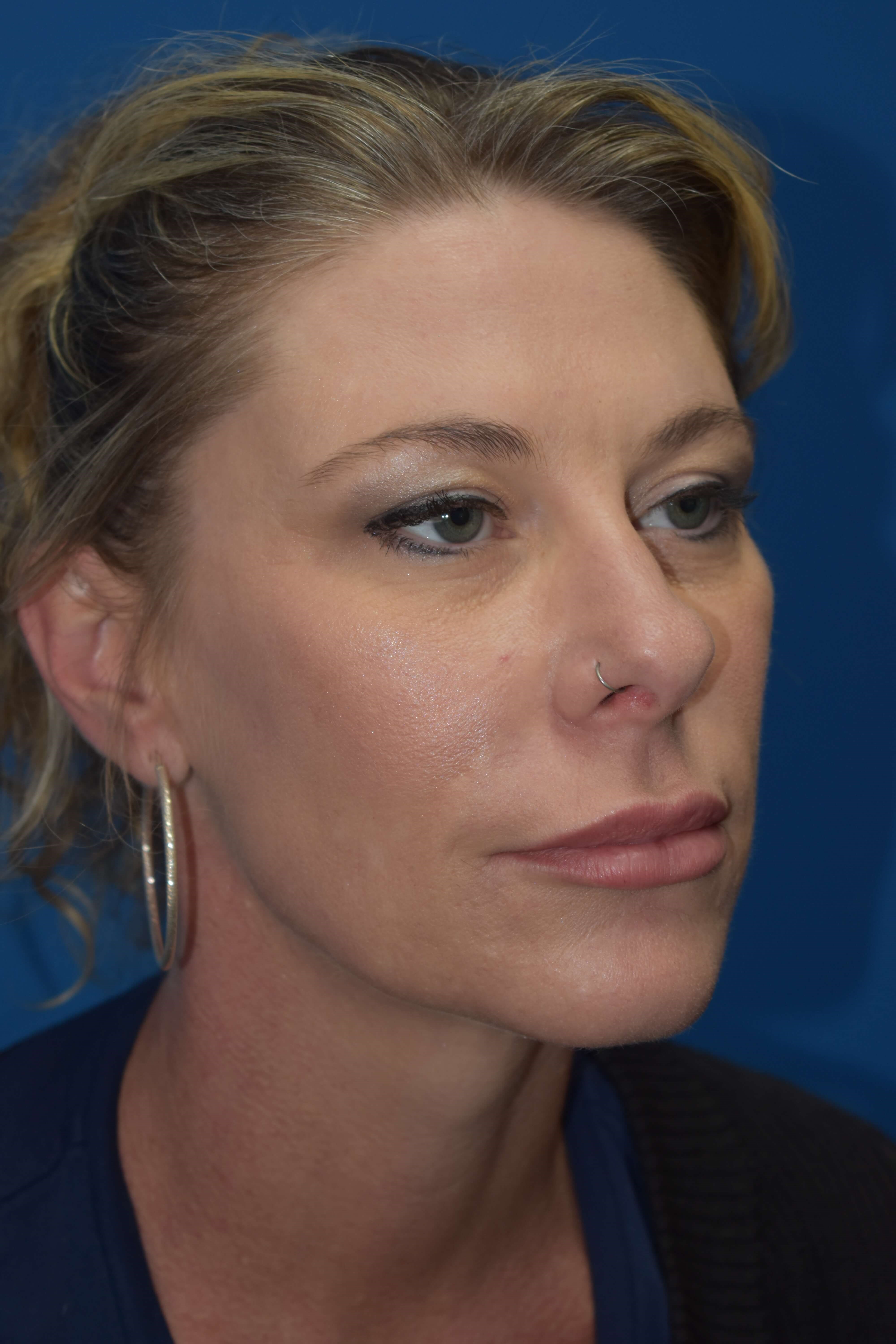 Lip and Nasolabial Fold Filler After