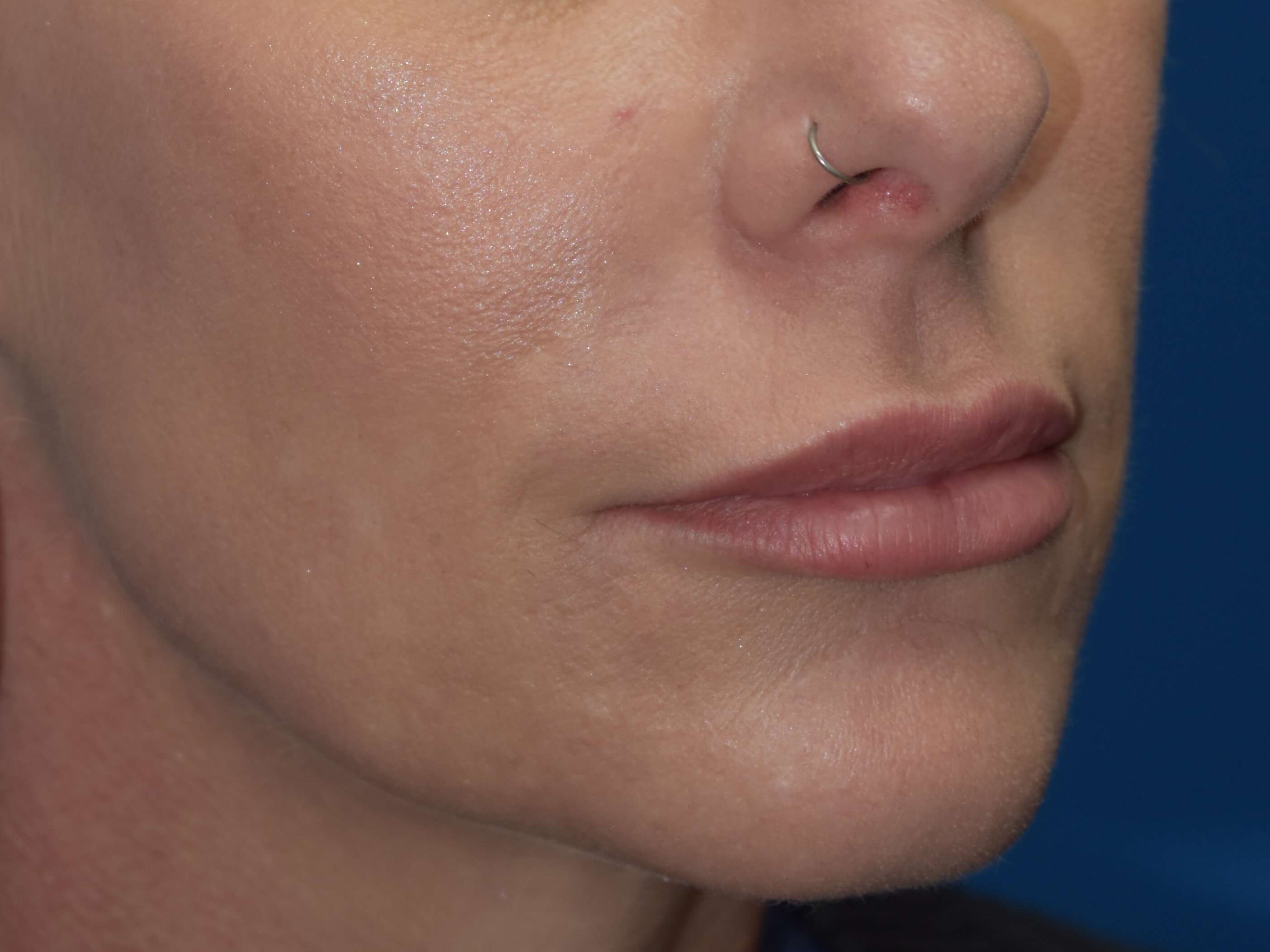 Lip and Nasolabial Fold Filler After
