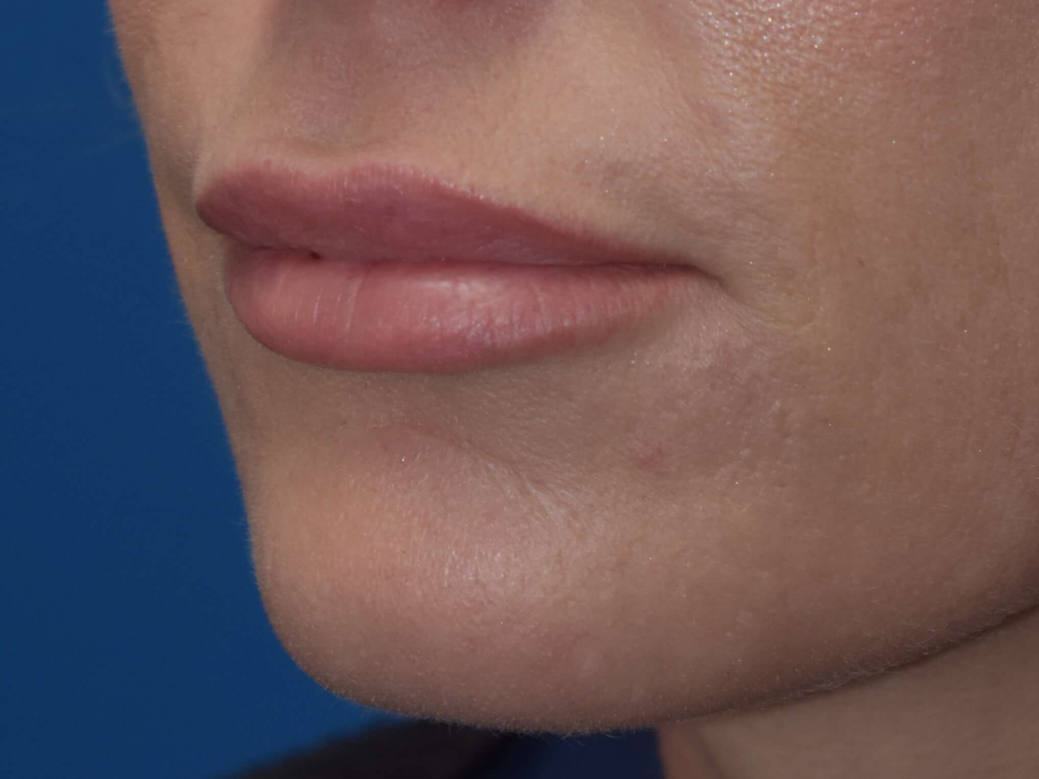 Lip Injections After