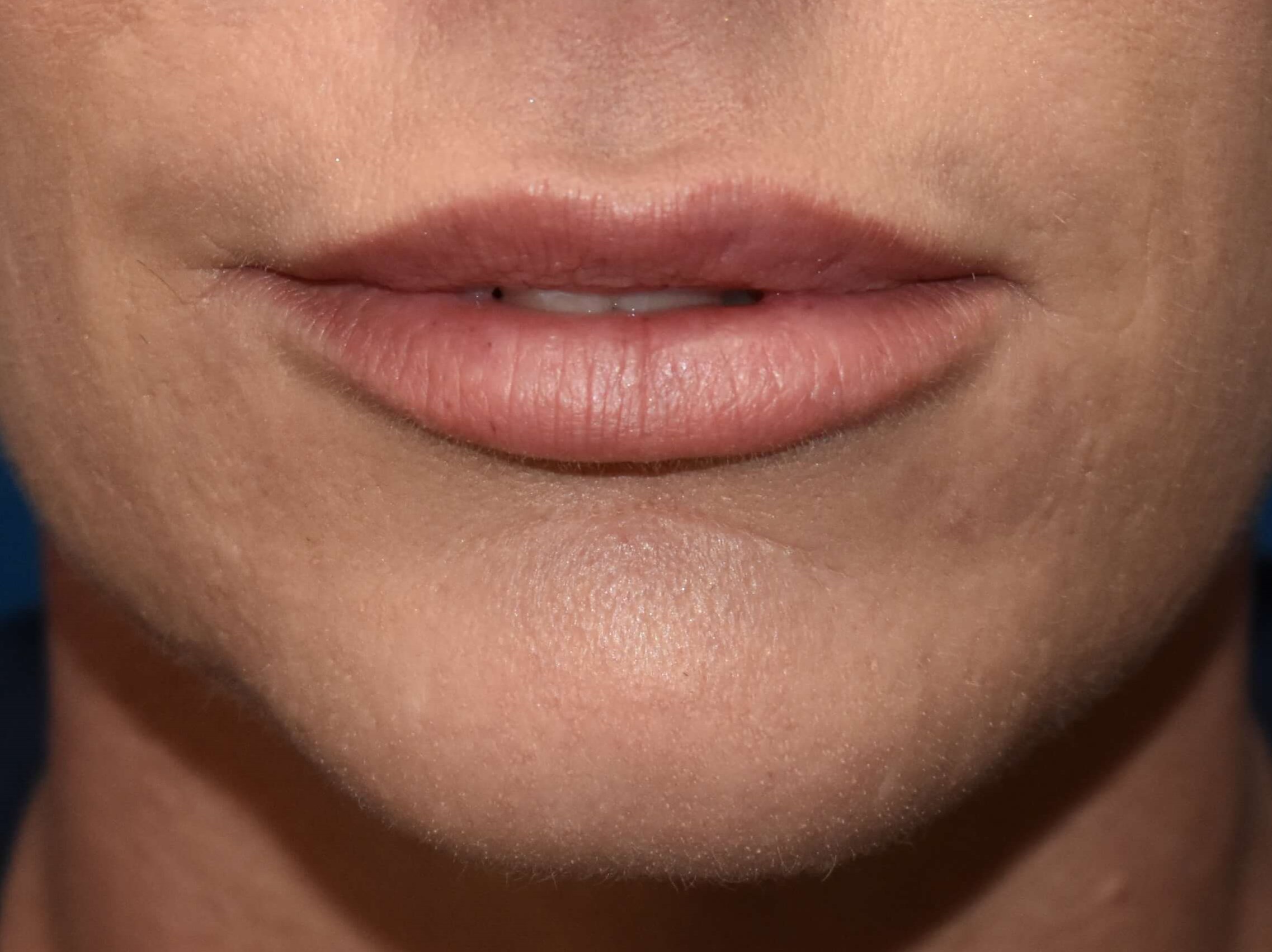 Lip Injections After