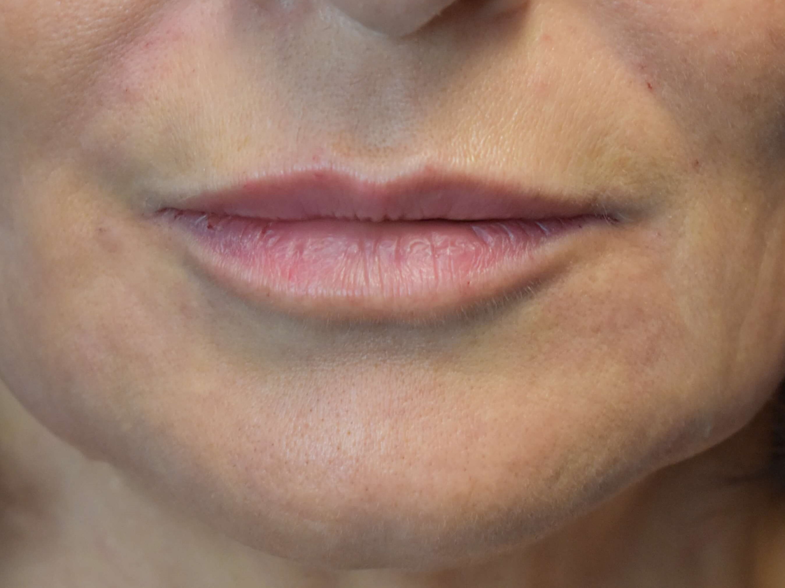 Lip and Marionette Filler After