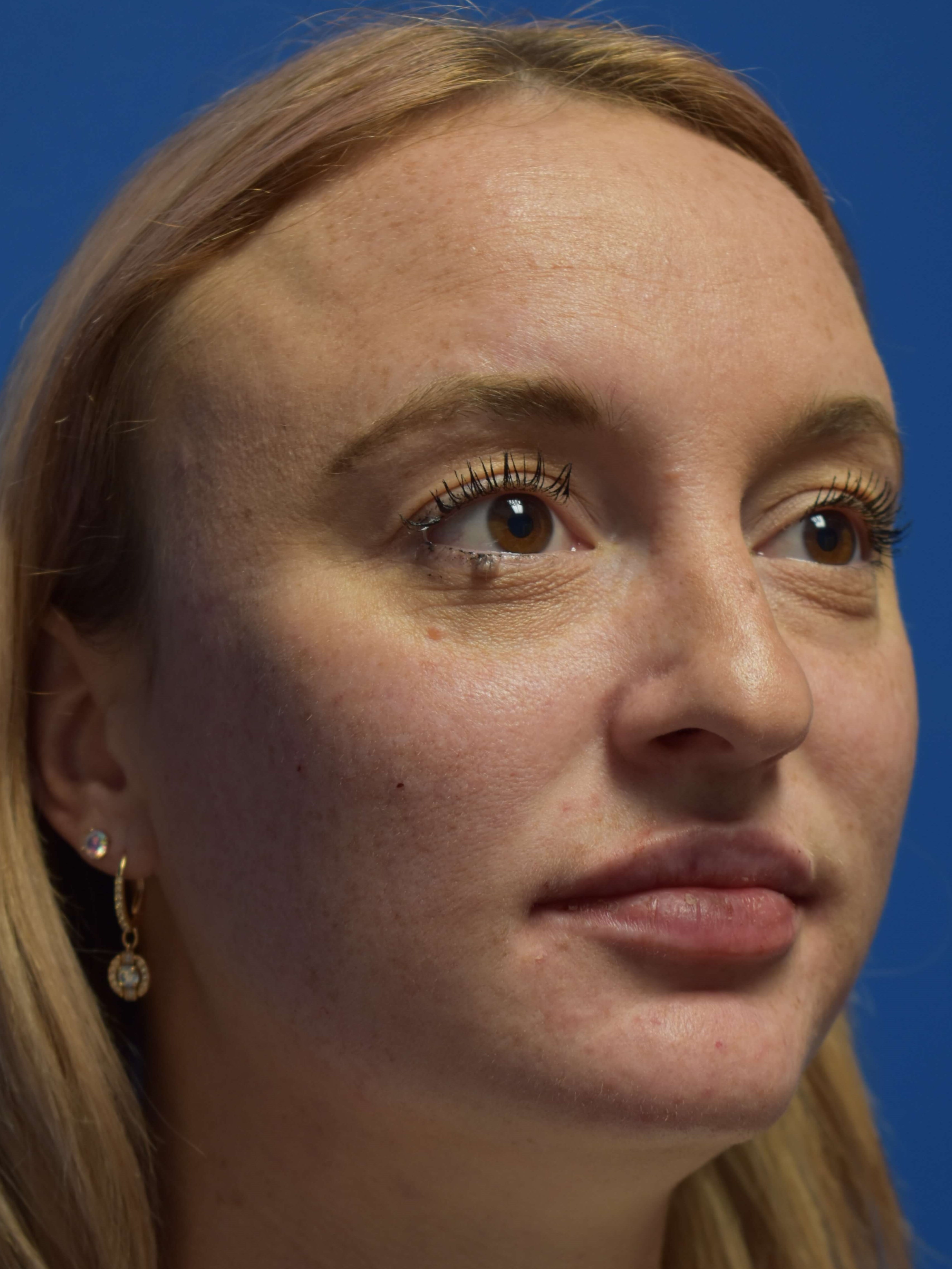 Cheek and Lip Filler Immediately After