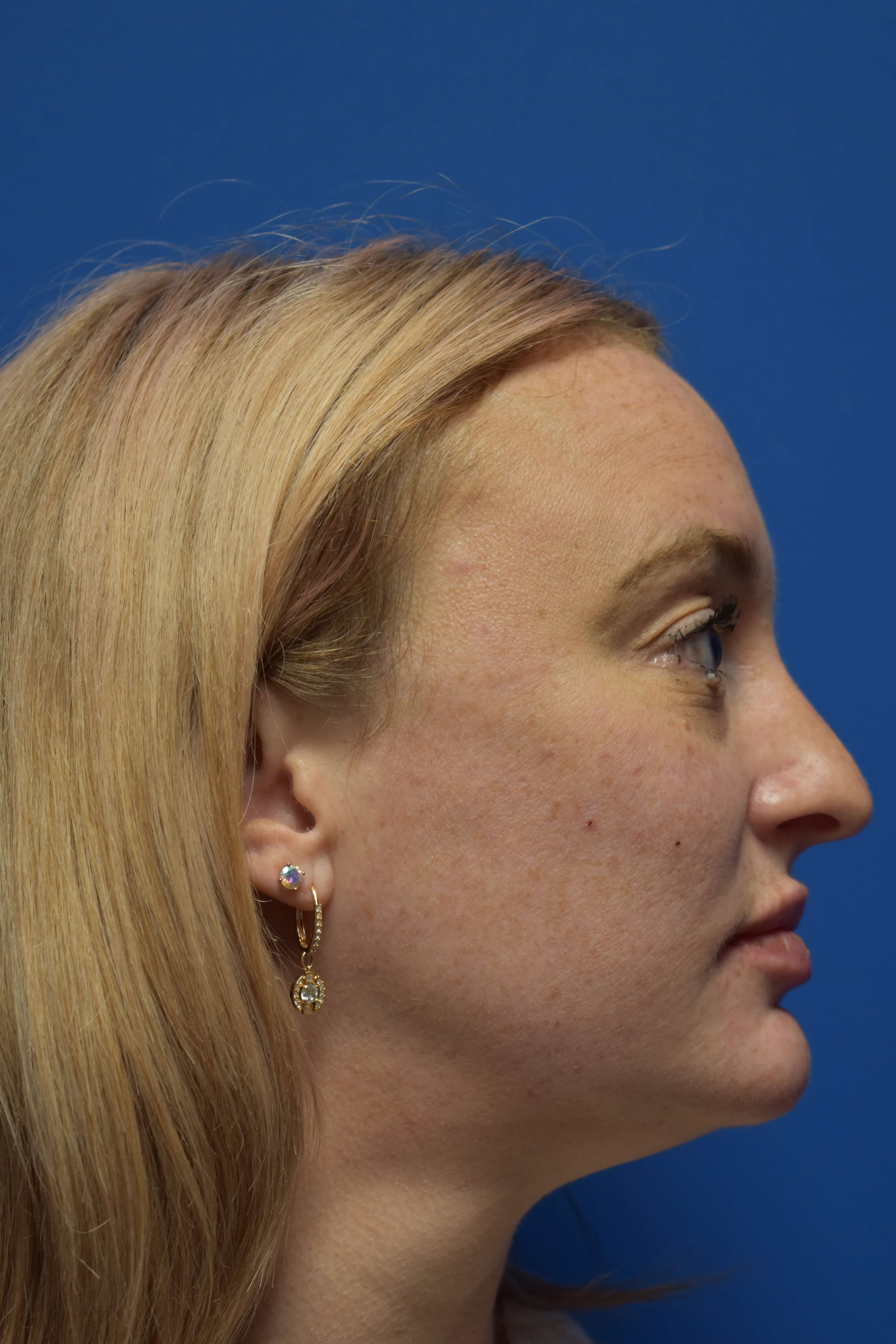 Cheek and Lip Filler Immediately After