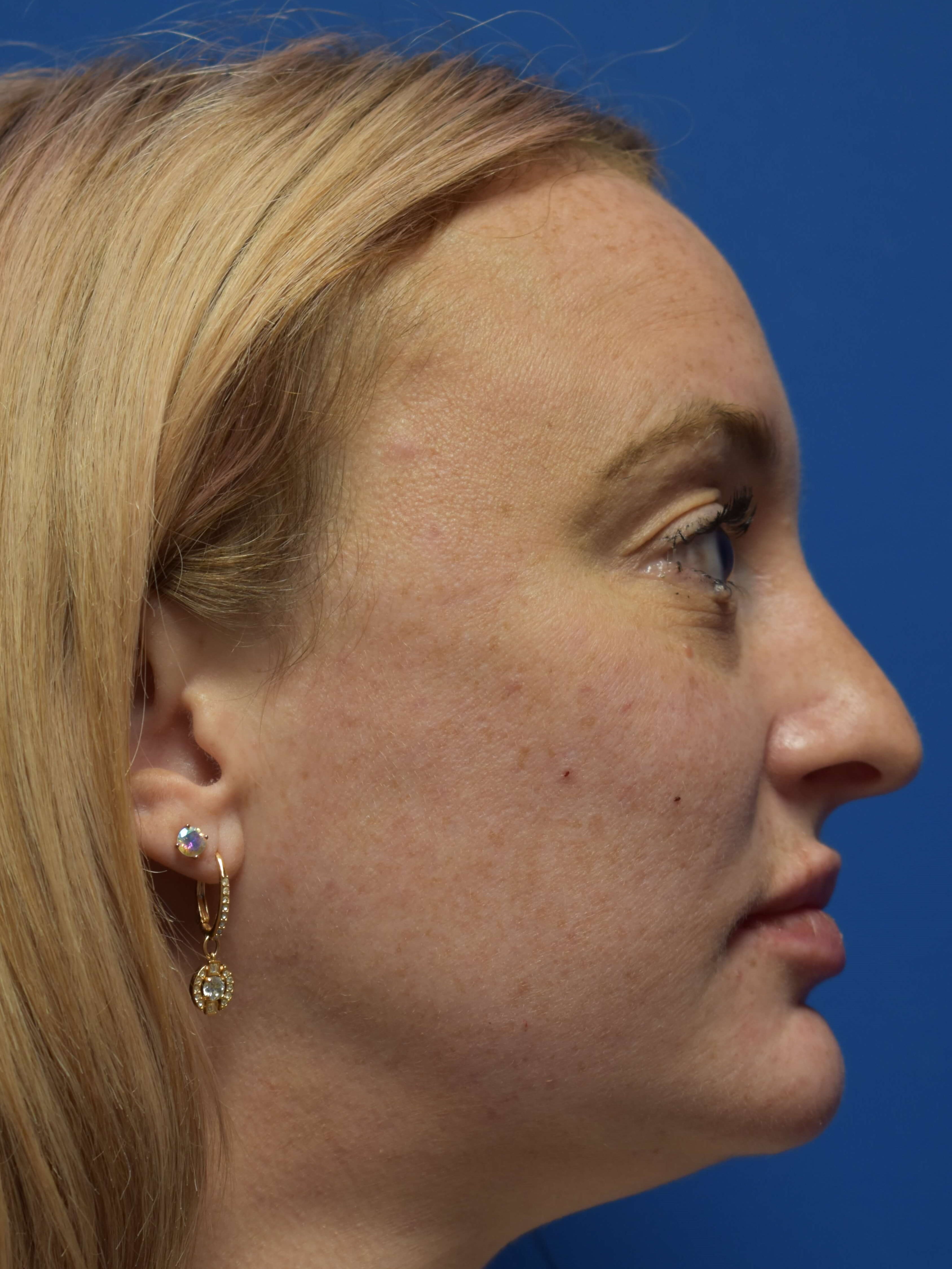 Cheek and Lip Filler Immediately After