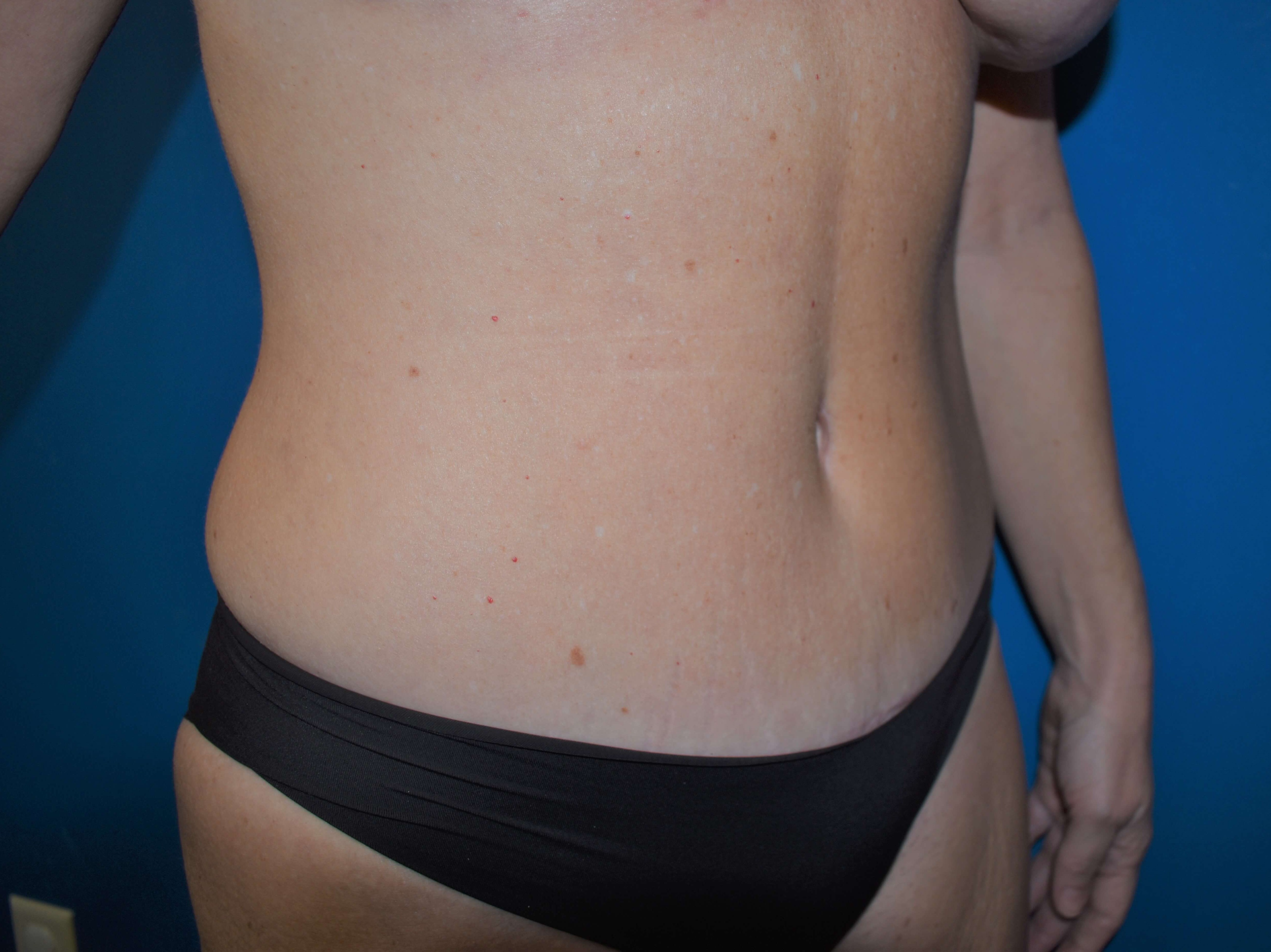 Oblique - Right After Abdominoplasty