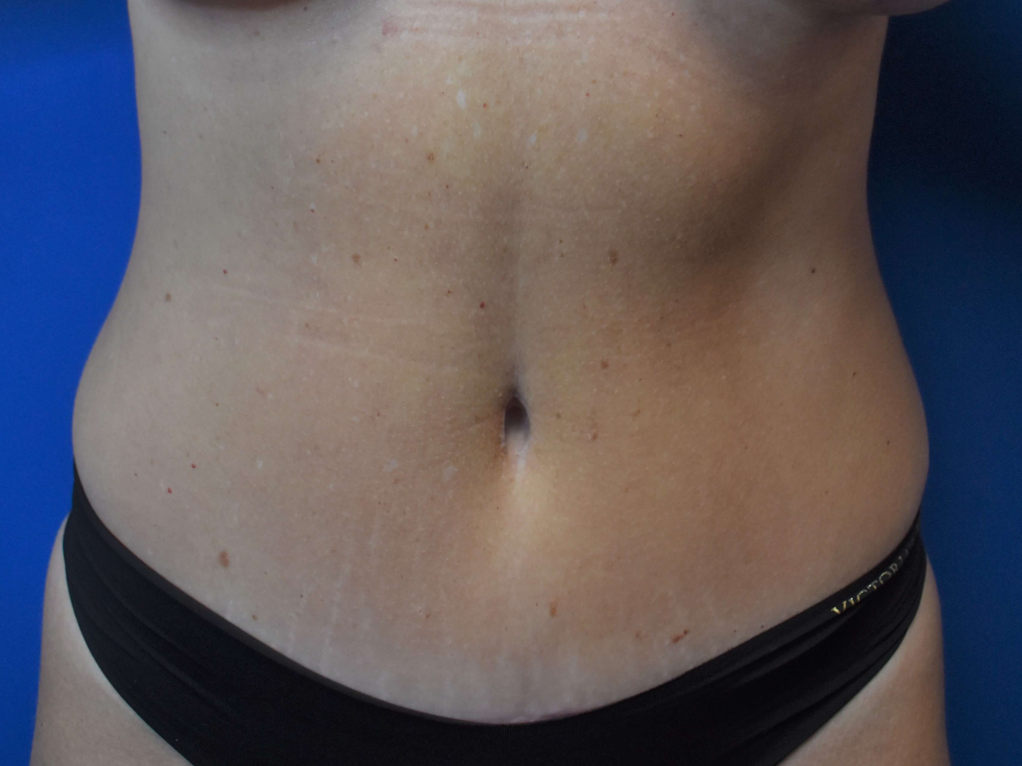 Front After Abdominoplasty