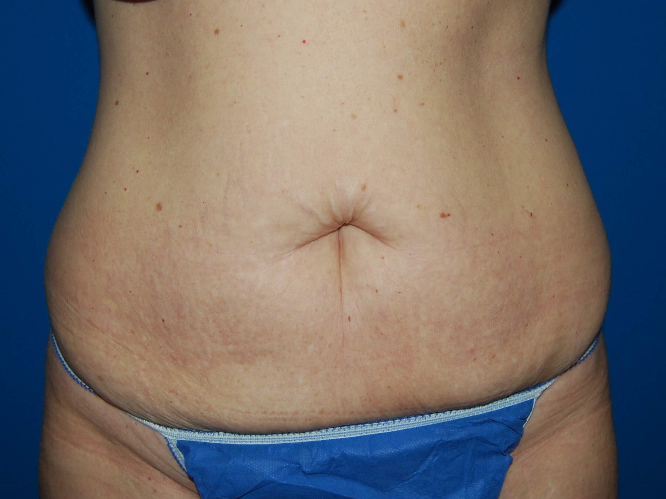 Front Before Abdominoplasty