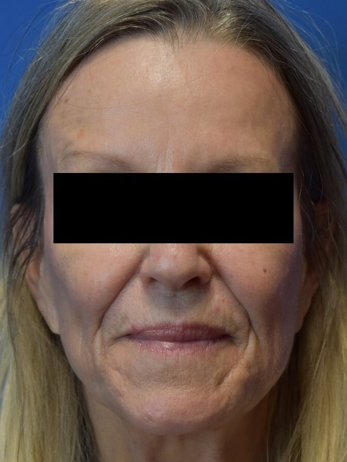 Nasolabial Fold + Cheek Filler Before
