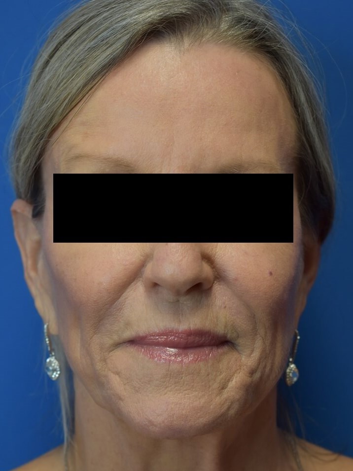 Nasolabial Fold + Cheek Filler After