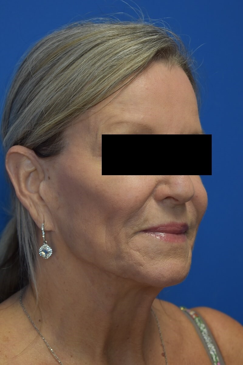 Nasolabial Fold + Cheek Filler After