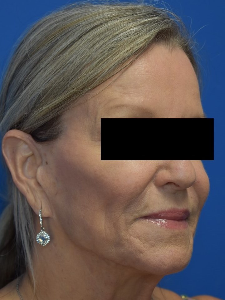 Nasolabial Fold + Cheek Filler After