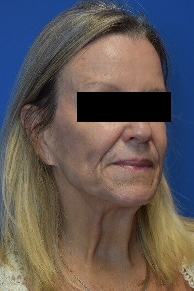 Nasolabial Fold + Cheek Filler Before