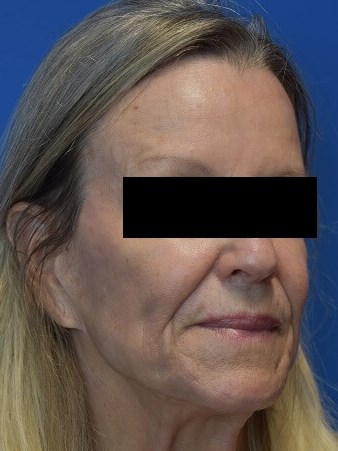 Nasolabial Fold + Cheek Filler Before