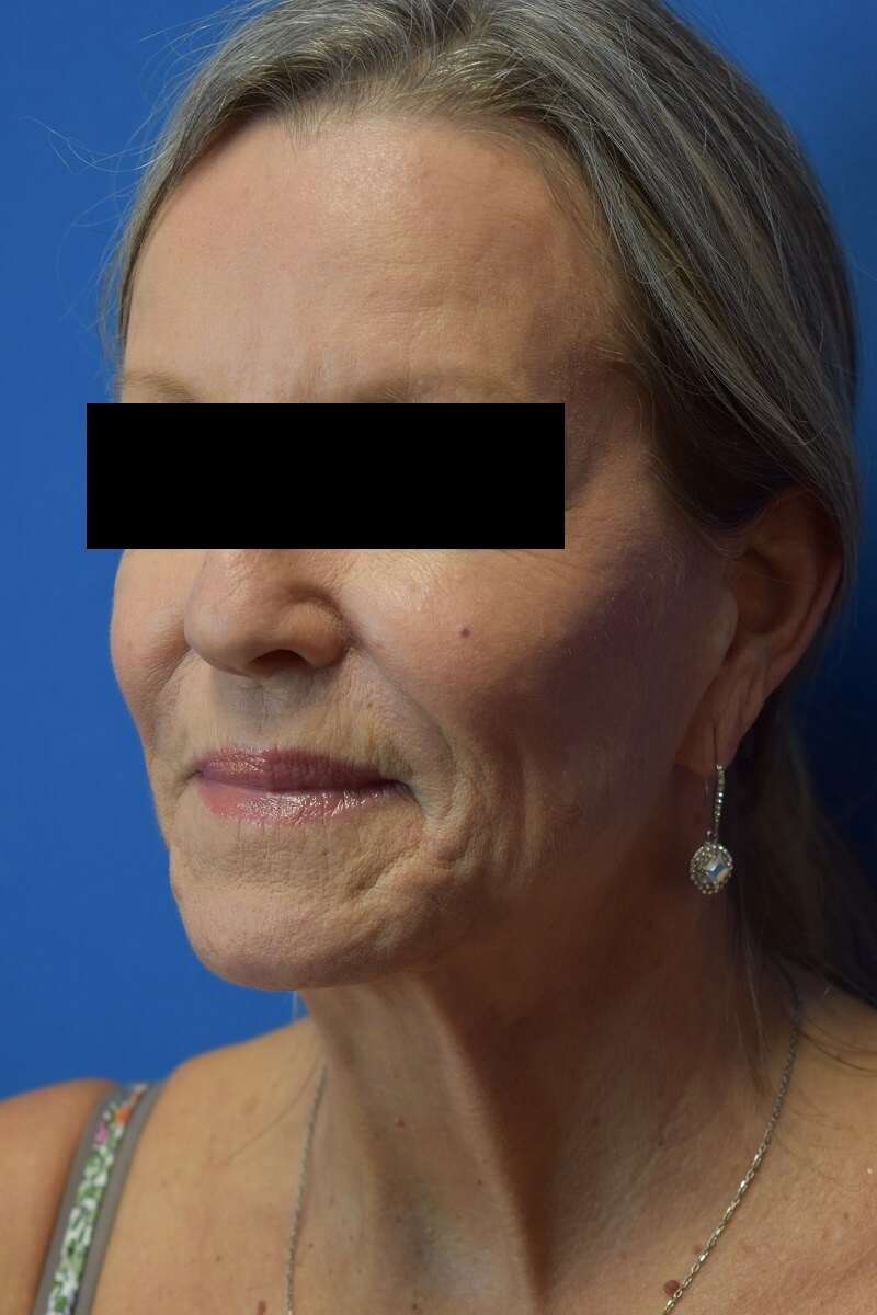 Nasolabial Fold + Cheek Filler After