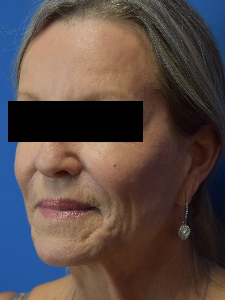Nasolabial Fold + Cheek Filler After