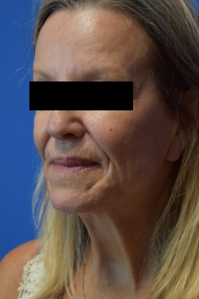 Nasolabial Fold + Cheek Filler Before
