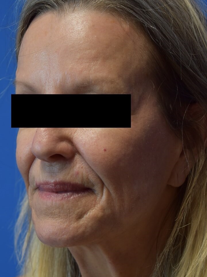 Nasolabial Fold + Cheek Filler Before