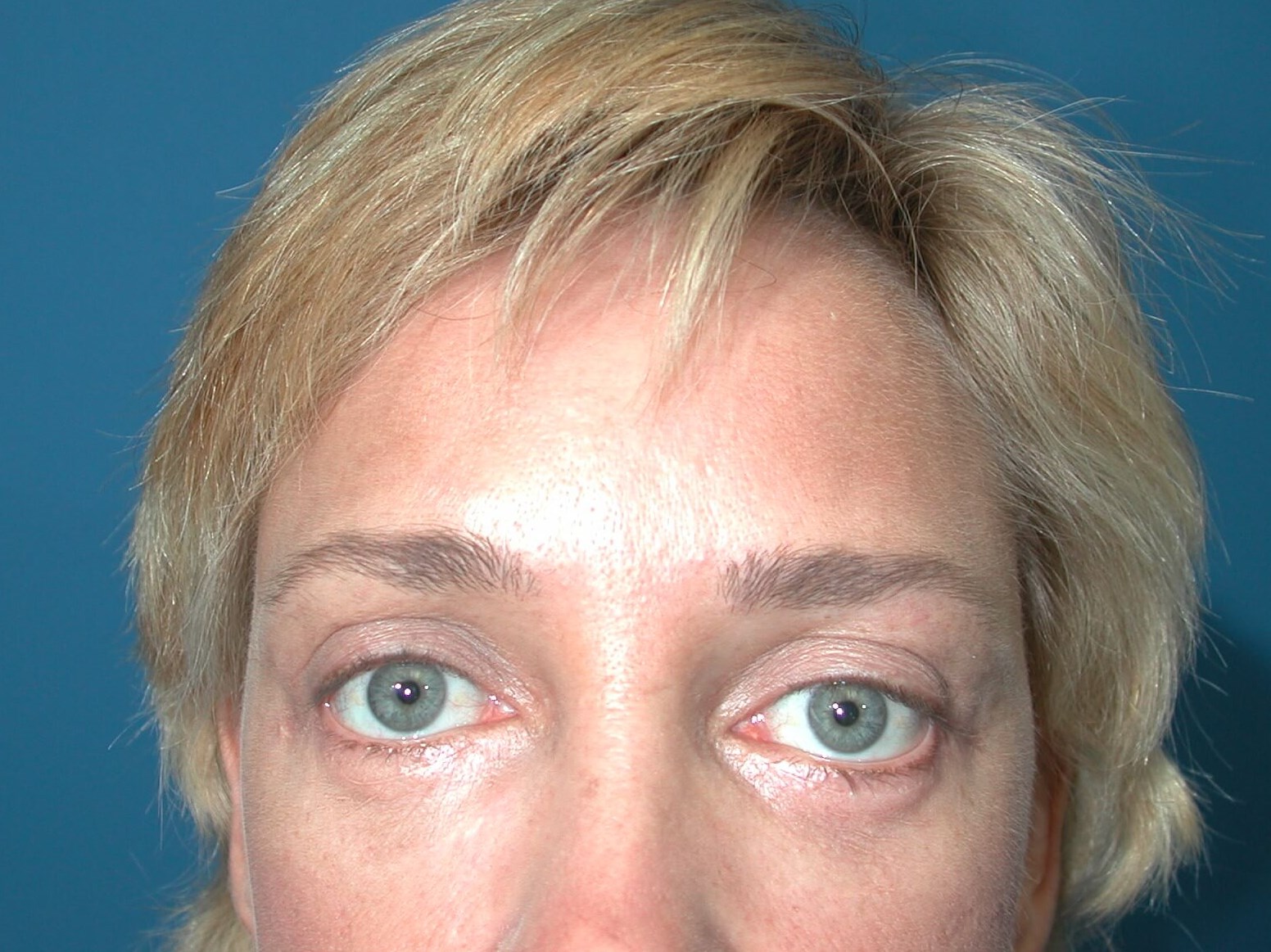 Eyelid Lift St. Pete After Eyelid Lift