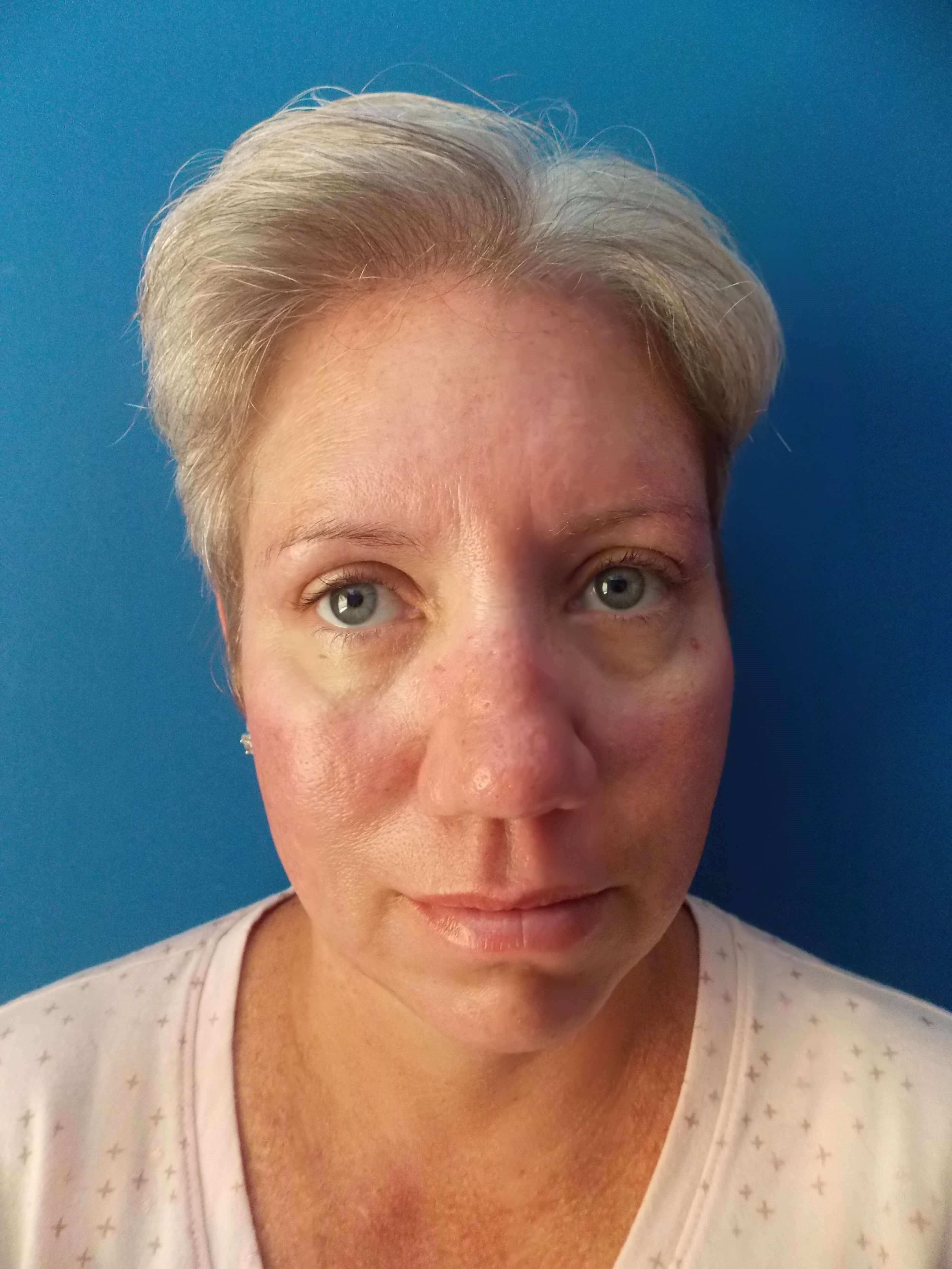 Broad Band Light Treatment Before