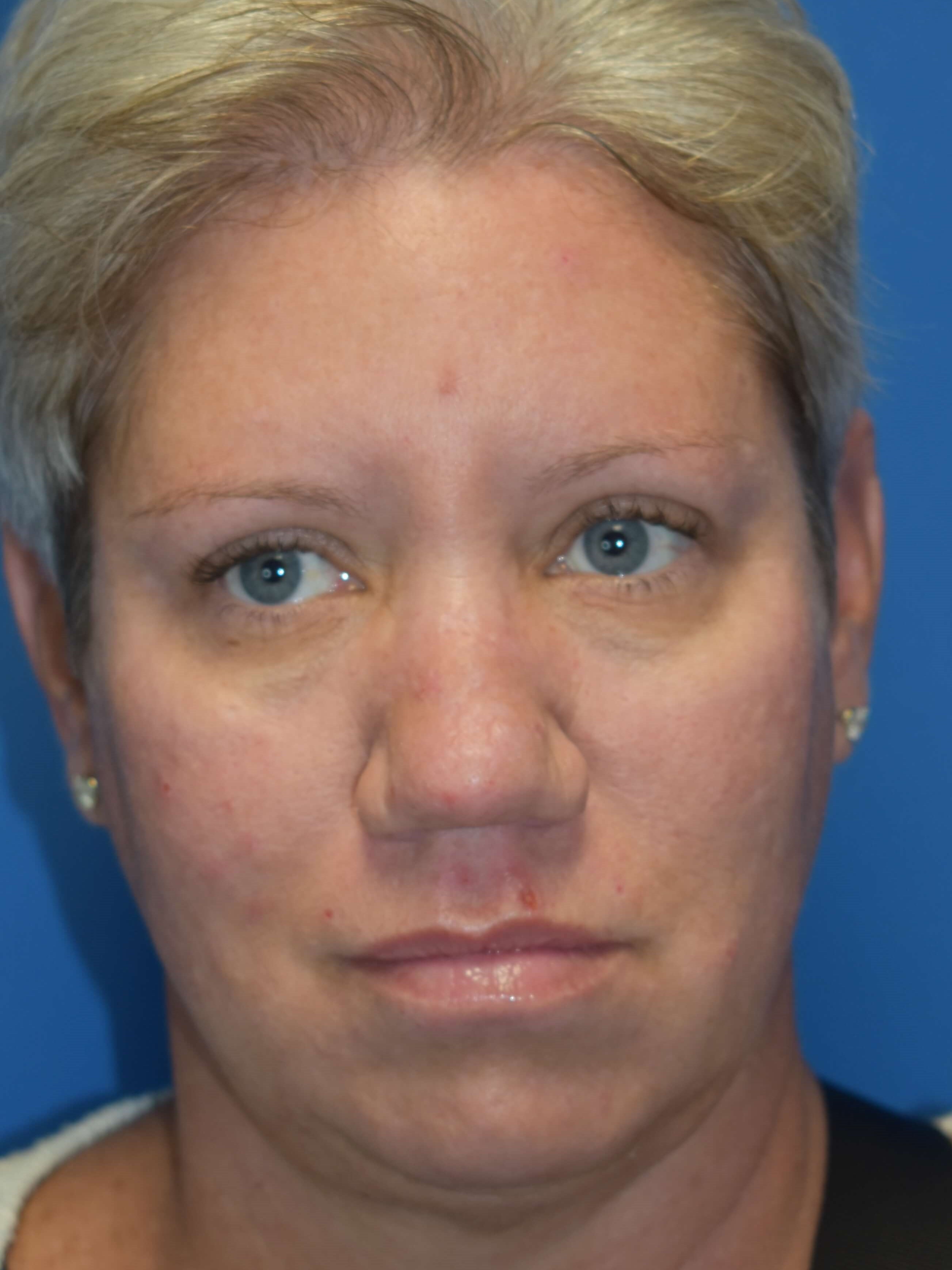 Broad Band Light Treatment After