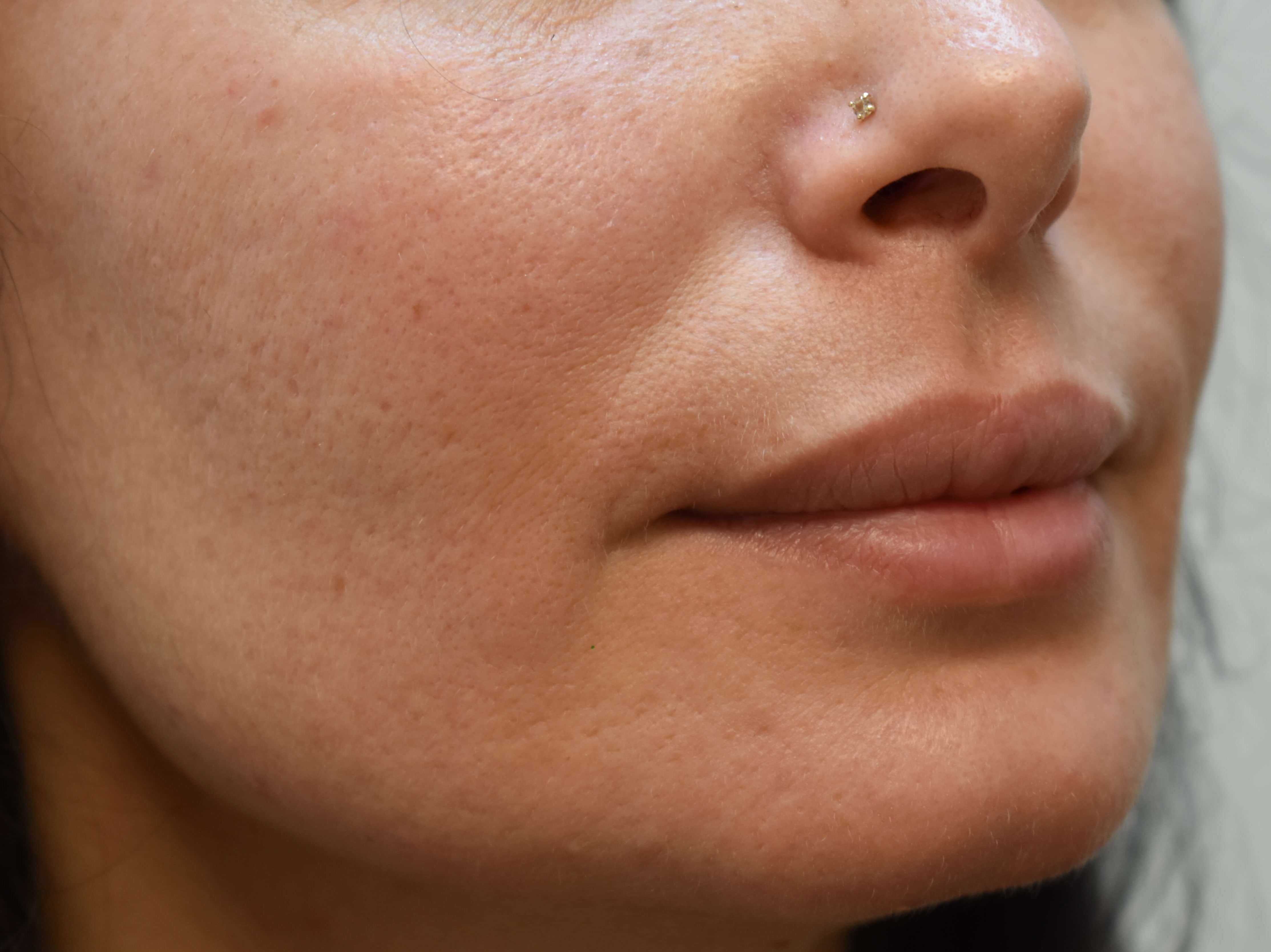 Lip Filler Before and After Before