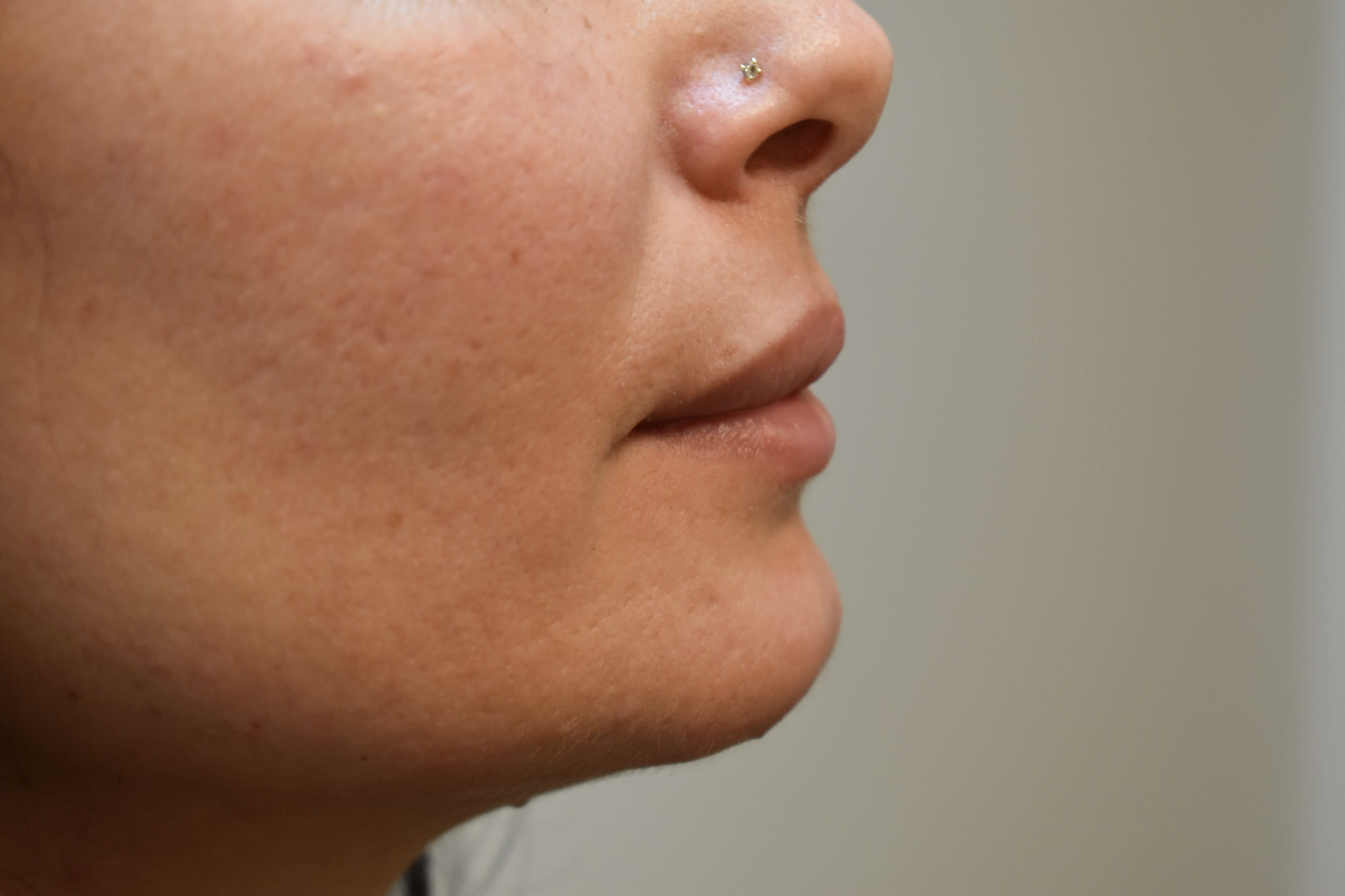 Lip Filler Before and After Before