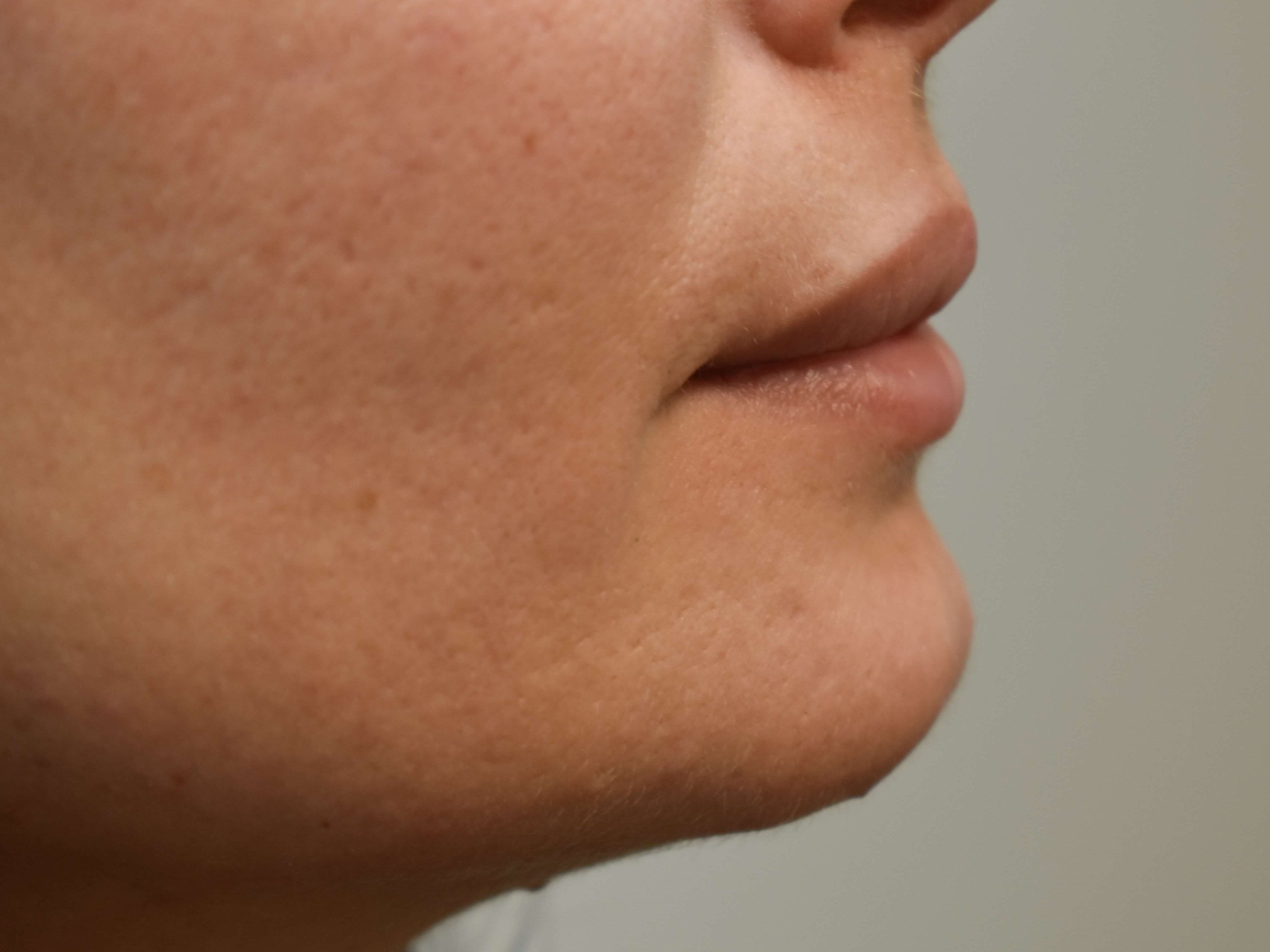 Lip Filler Before and After Before