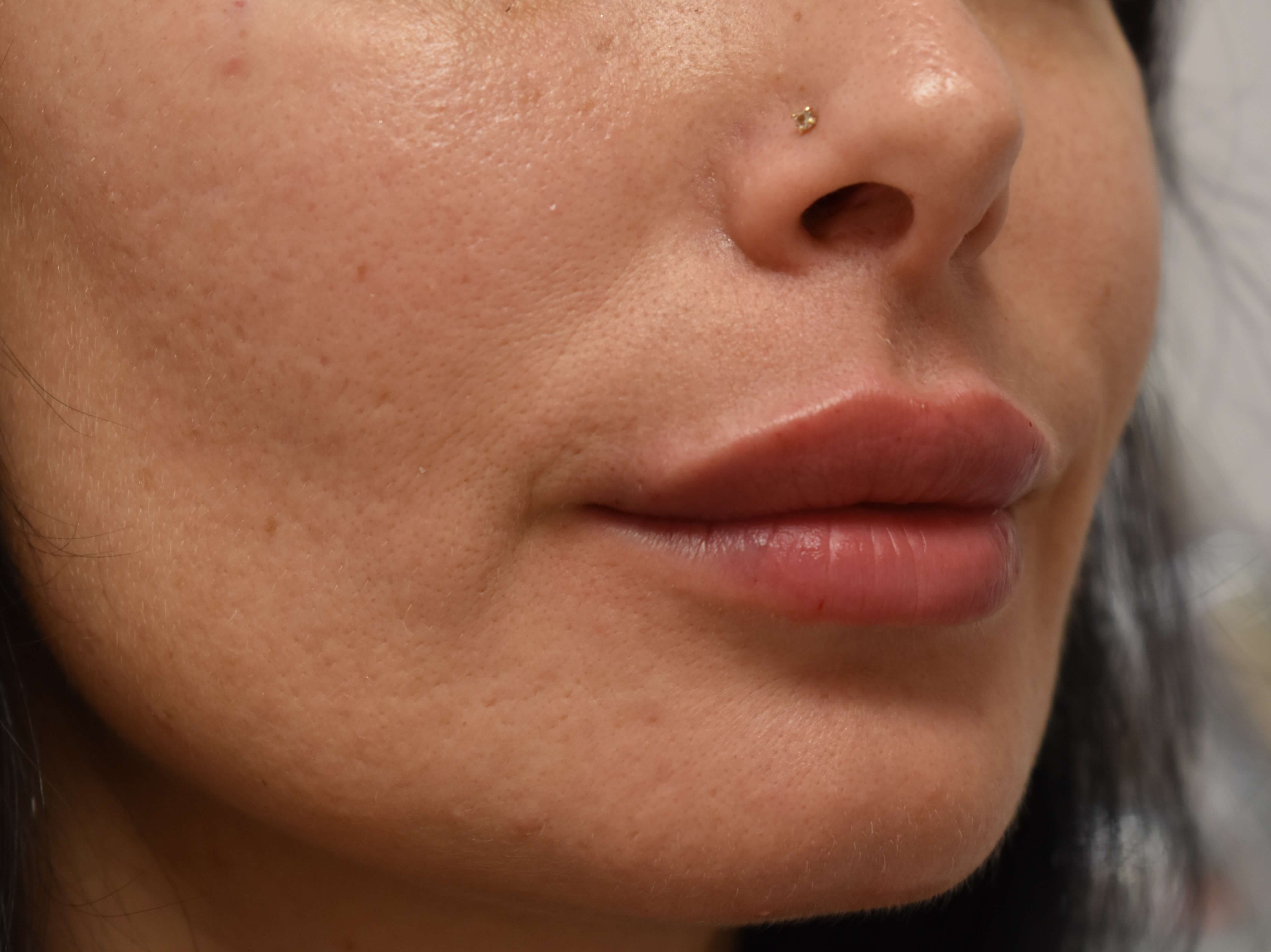 Lip Filler Before and After After