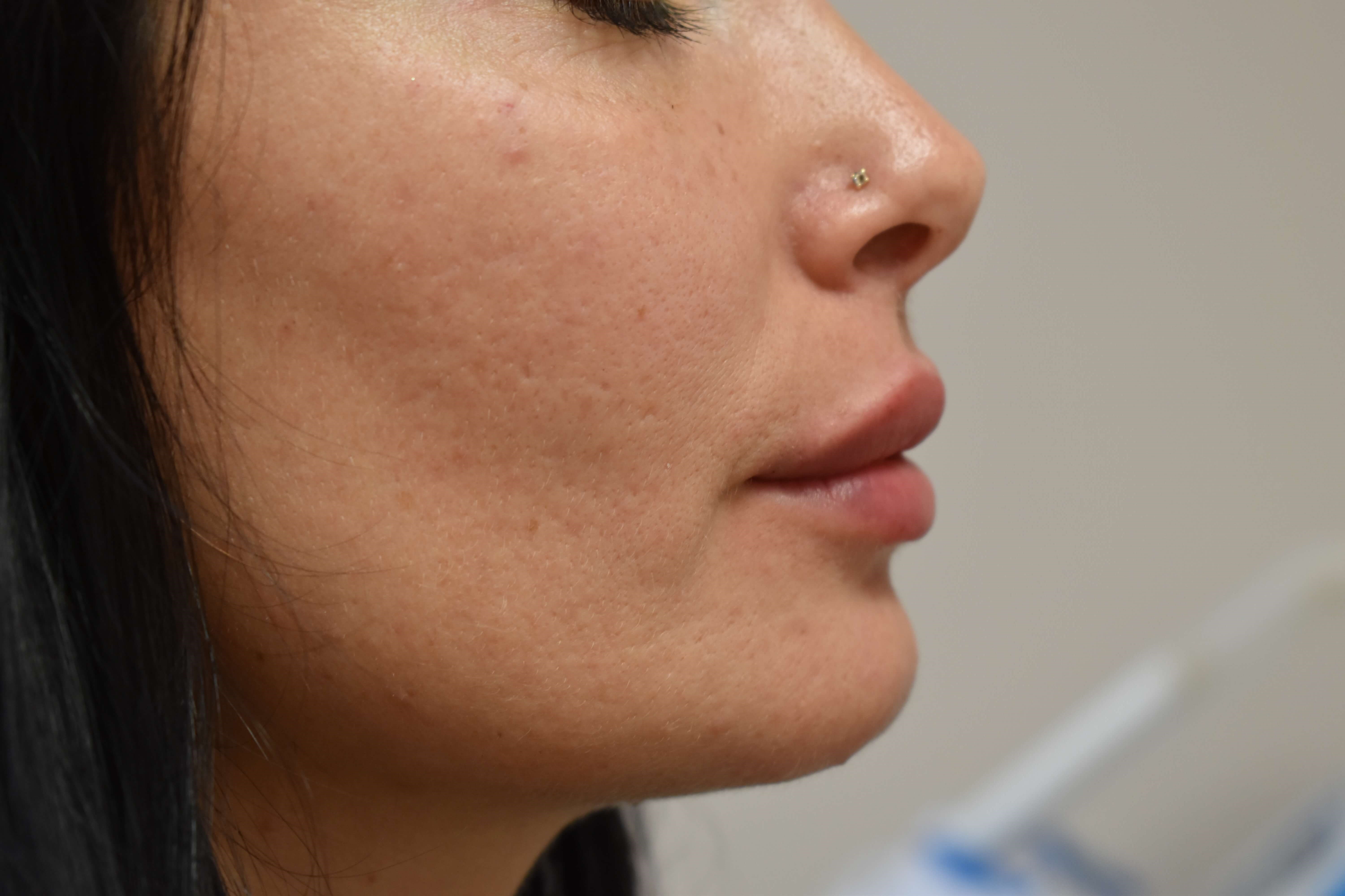 Lip Filler Before and After After